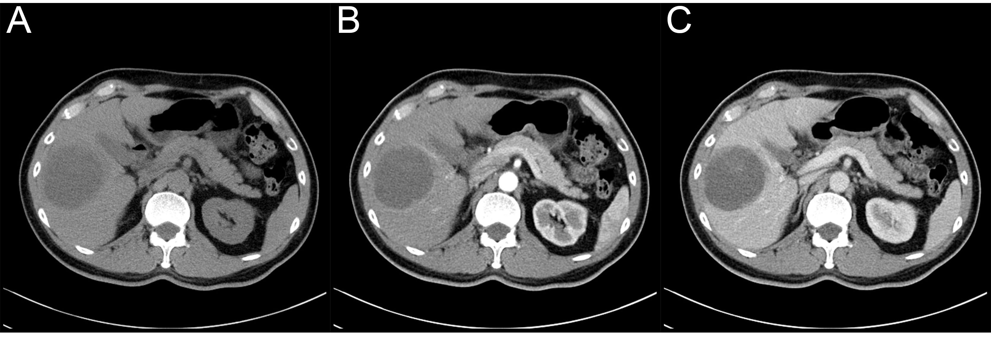 Preoperative CT evaluation (A) plain CT scanning (B) artery 
phase of enhanced CT scanning (C) portal vein phase of enhanced CT scanning.