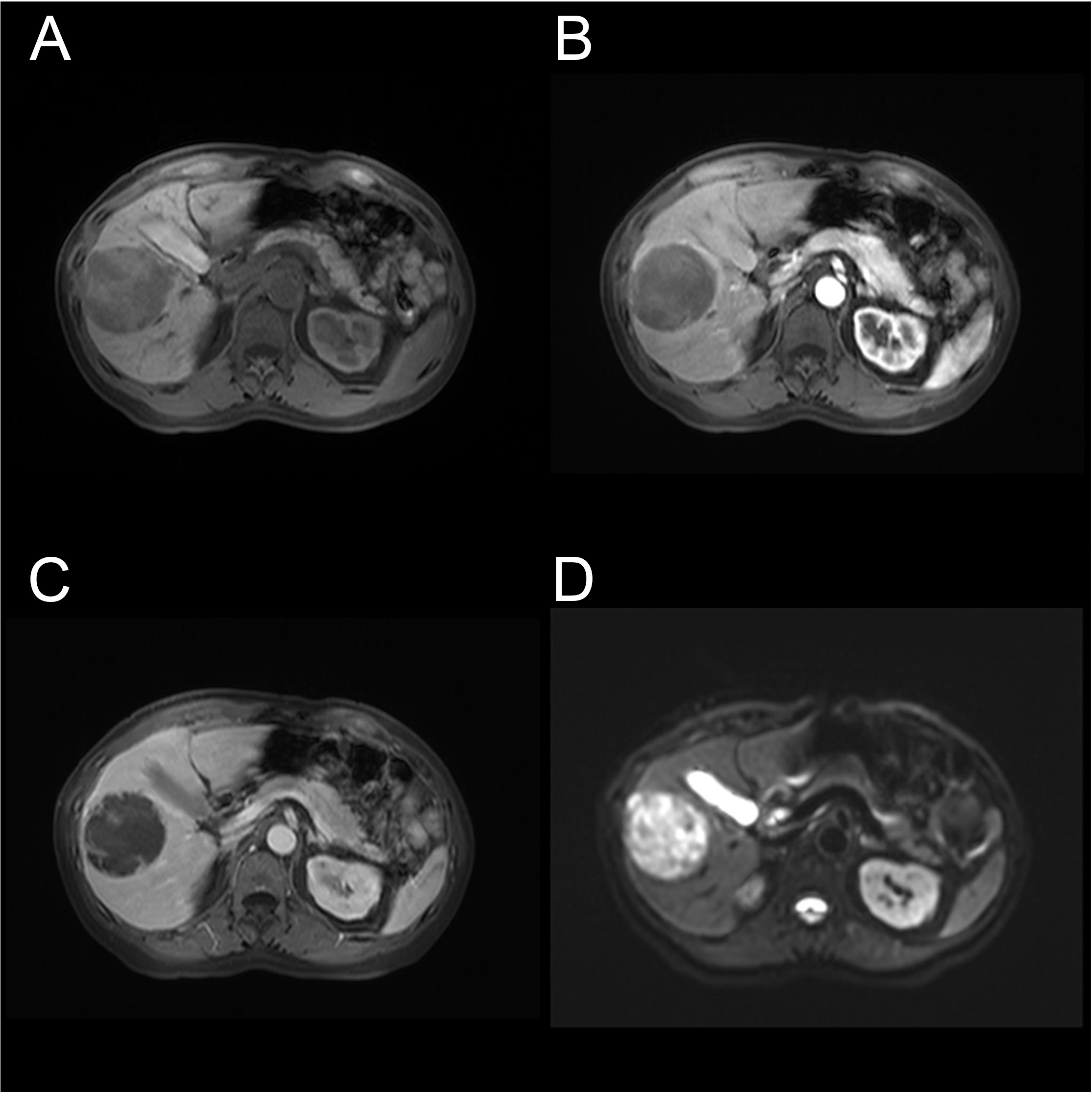 Preoperative MRI evaluation. (A) T1 weighted 
scanning. (B) Artery phase of enhanced MRI scanning. (C) Portal vein phase of 
enhanced MRI scanning. (D) DWI scanning.