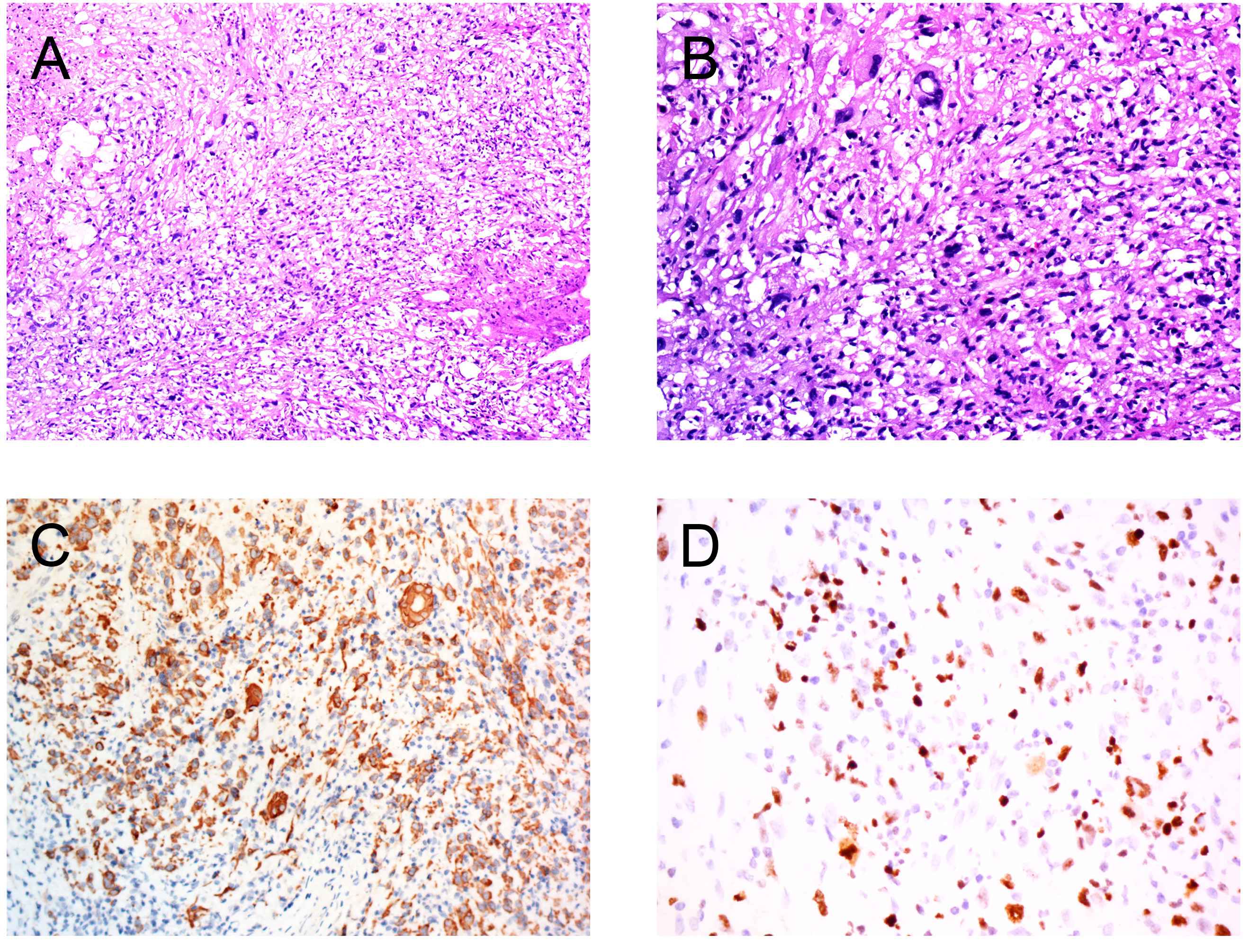 Representative pathological and immunohistochemical images of 
the second surgery specimen. (A) HE staining (10×). (B) HE staining 
(20×). (C) CK staining. (D) Ki-67 staining.