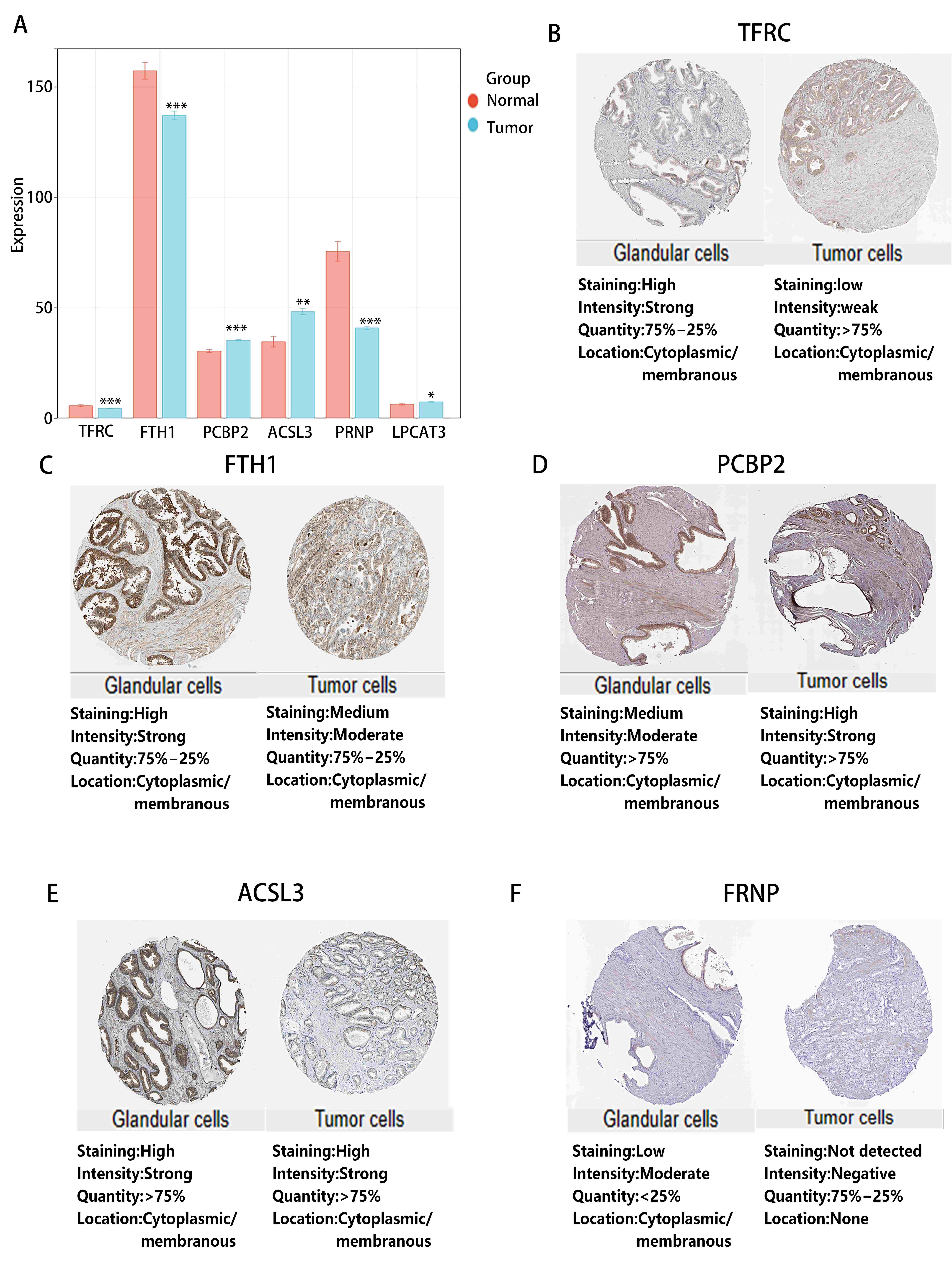 The expression and
prognostic value analyses of each signature. (A) The expression of 6 signatures
in the PRAD group in comparison with the normal group. (B–F) The protein level
of signatures in PRAD.