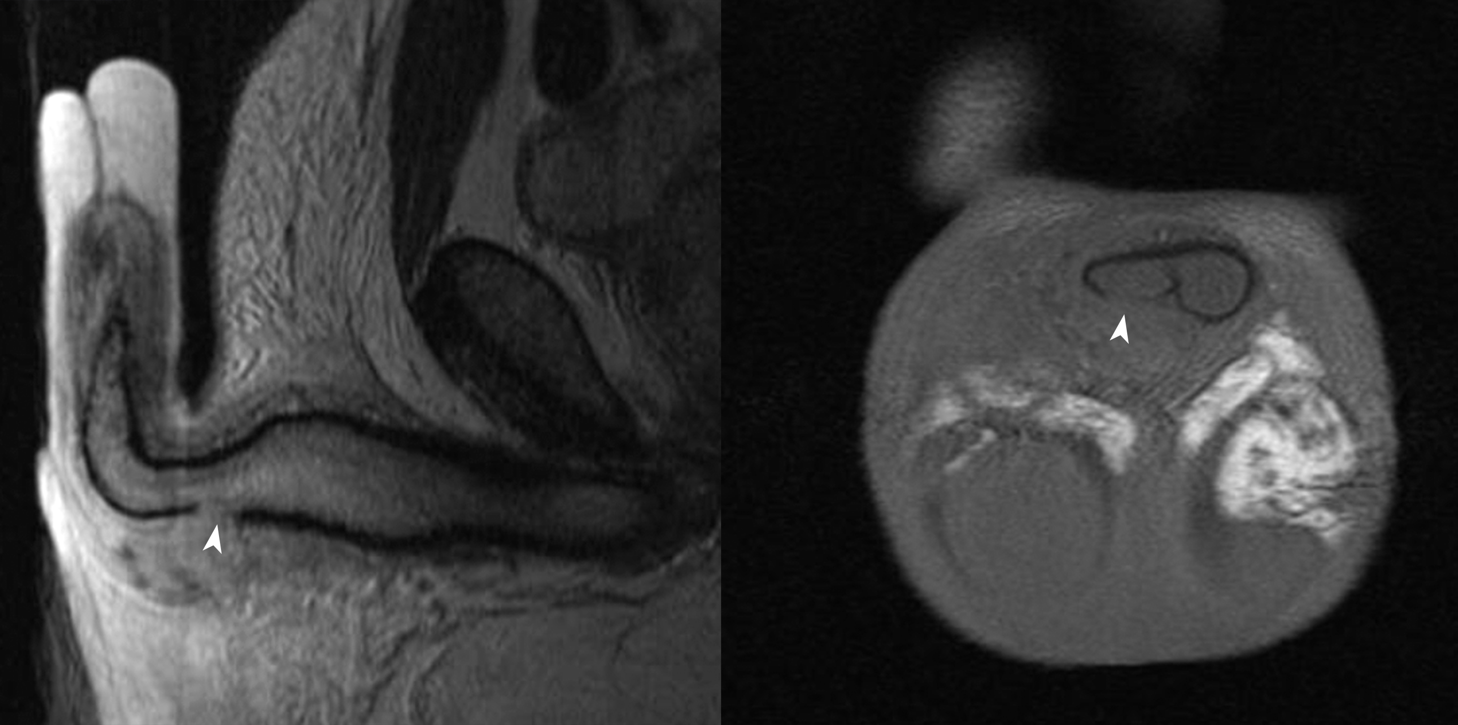 Defect in Tunica Albuginea
(white arrow) on T2-weighted Sagittal and T1-weighted Coronal MRI.