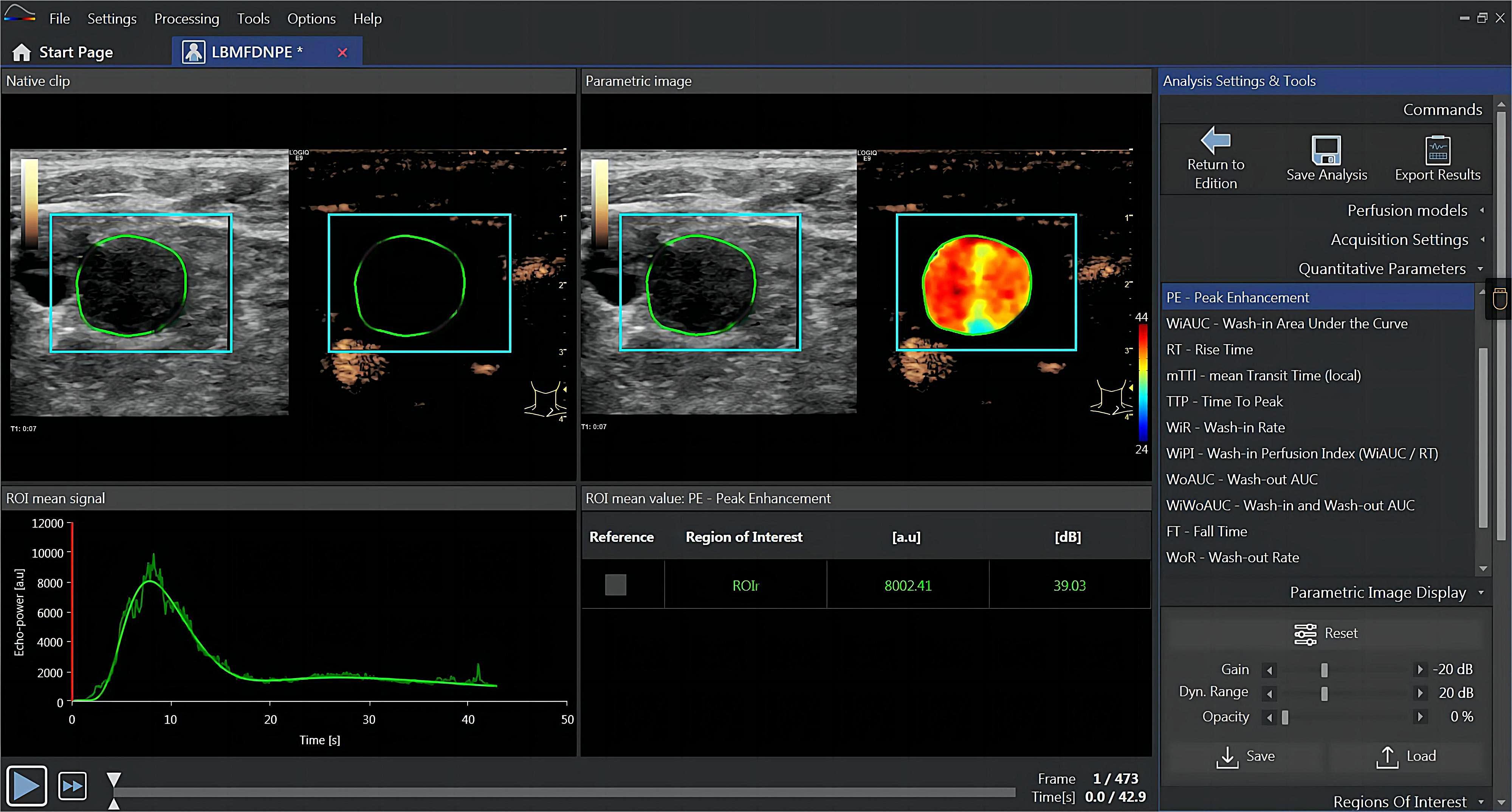 Vuebox analysis interface 
for metastatic lymph nodes in the neck of lung cancer.