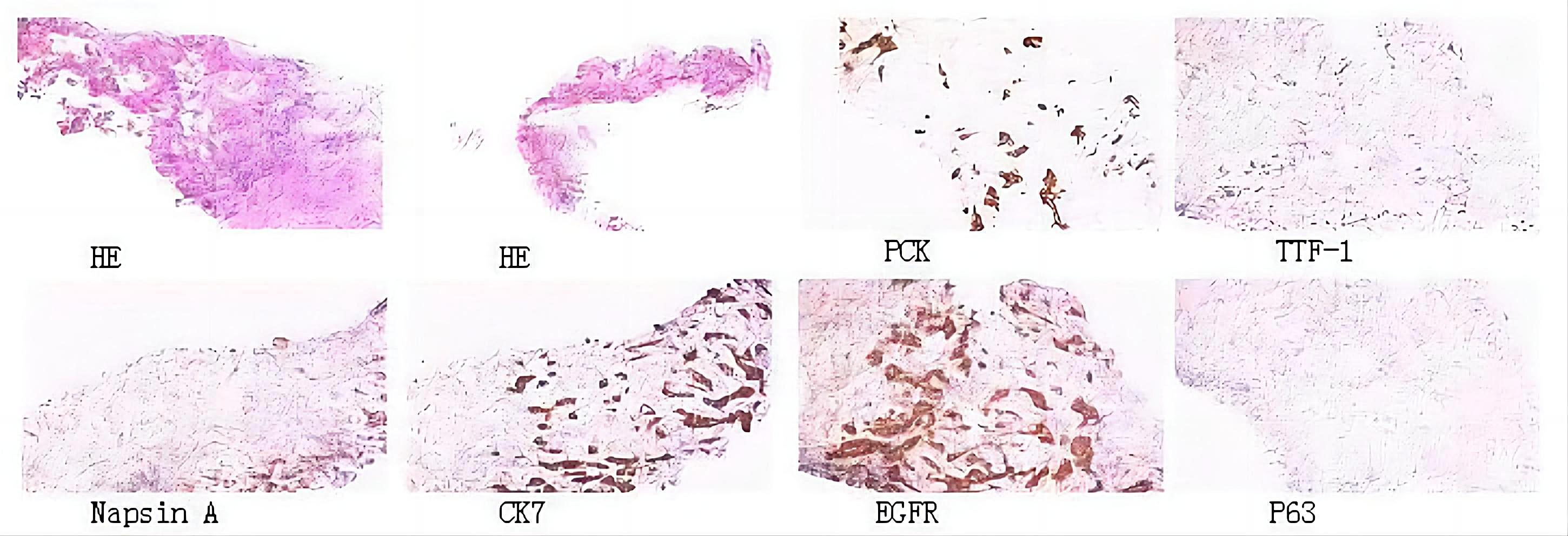 Pathological image of 
cervical lymph node metastasis of lung cancer. HE: haematoxylin and eosin; PCK: 
pan cytokeratin; TTF-1: thyroid transcription factor-l; CK7: cytokeratin 7; EGFR: 
epidermal growth factor receptor; P63: recombinant tumor protein P63.