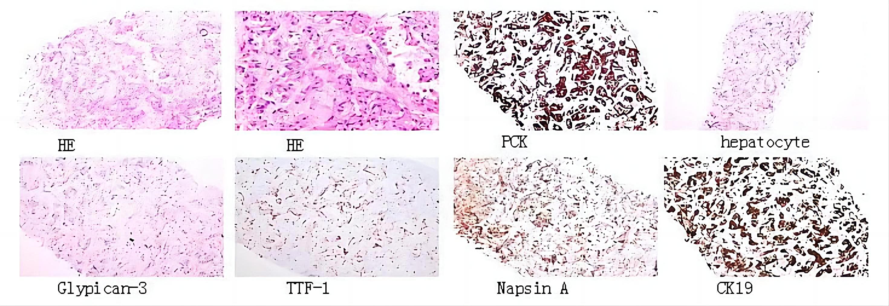 Pathological image of 
cervical benign reactive hyperplasia lymph nodes. HE: haematoxylin and eosin; 
PCK: pan cytokeratin; TTF-1: thyroid transcription factor-l; CK19: cytokeratin 
19.