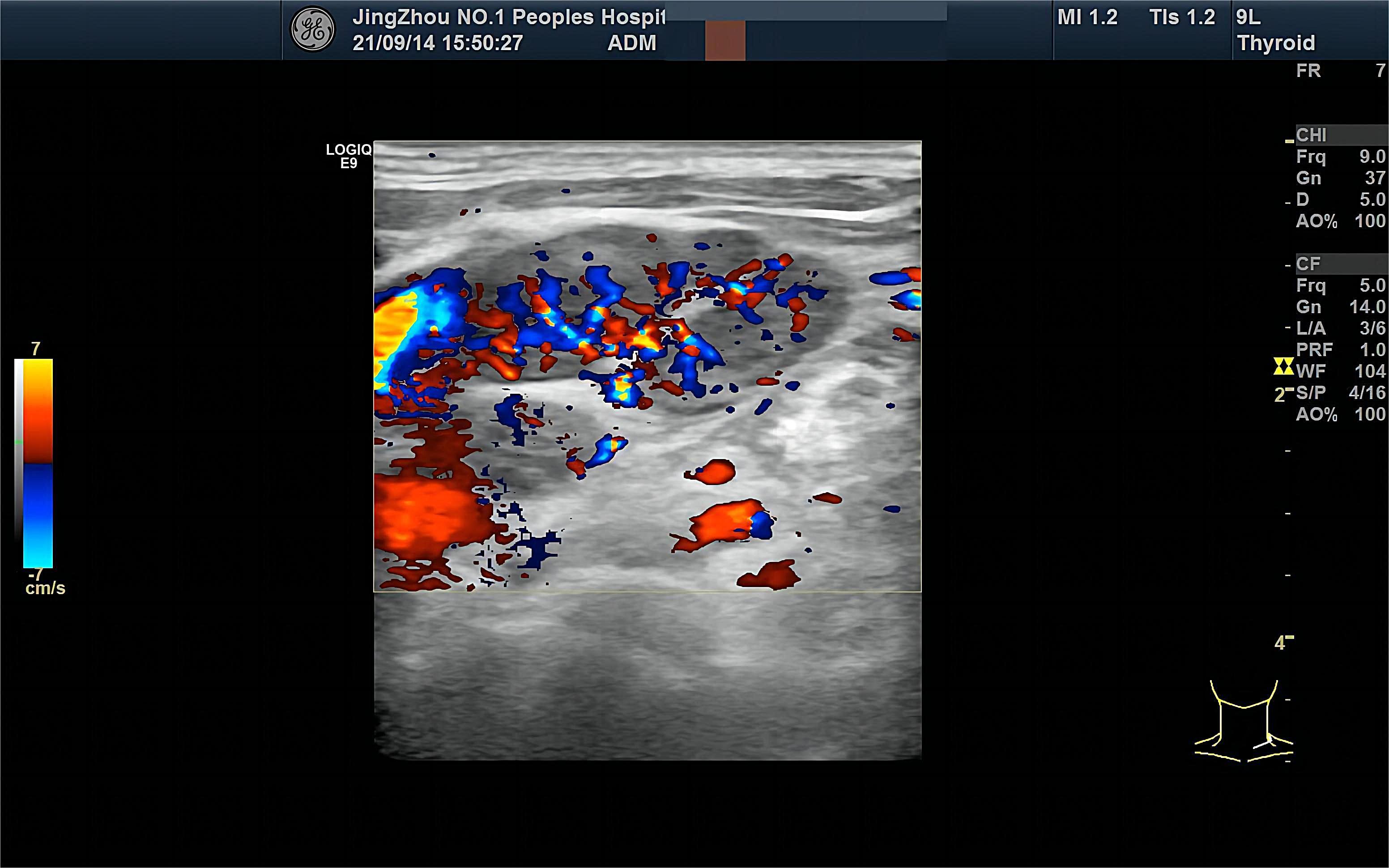 Benign reactive 
hyperplastic lymph nodes. FR: frame rat; CHI: contrast harmonic imaging; Frq: frequency; 
Gn: Gain; D: depth; AO: acoustic output; PRF: pulse repetition frequency; L/A: 
line density/frame average; WF: wall filter; S/P: spatial filter/ packet size; 
CF: color flow.