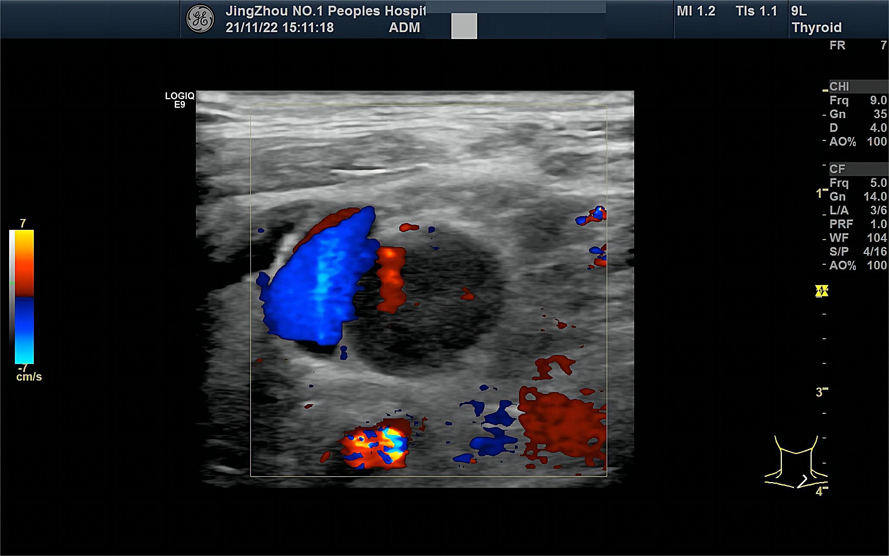 Metastatic lymph nodes of 
lung cancer. FR: frame rat; CHI: contrast harmonic imaging; Frq: frequency; Gn: Gain; D: depth; AO: acoustic output; PRF: 
pulse repetition frequency; L/A: line density/frame average; WF: wall filter; 
S/P: spatial filter/packet size; CF: color flow.