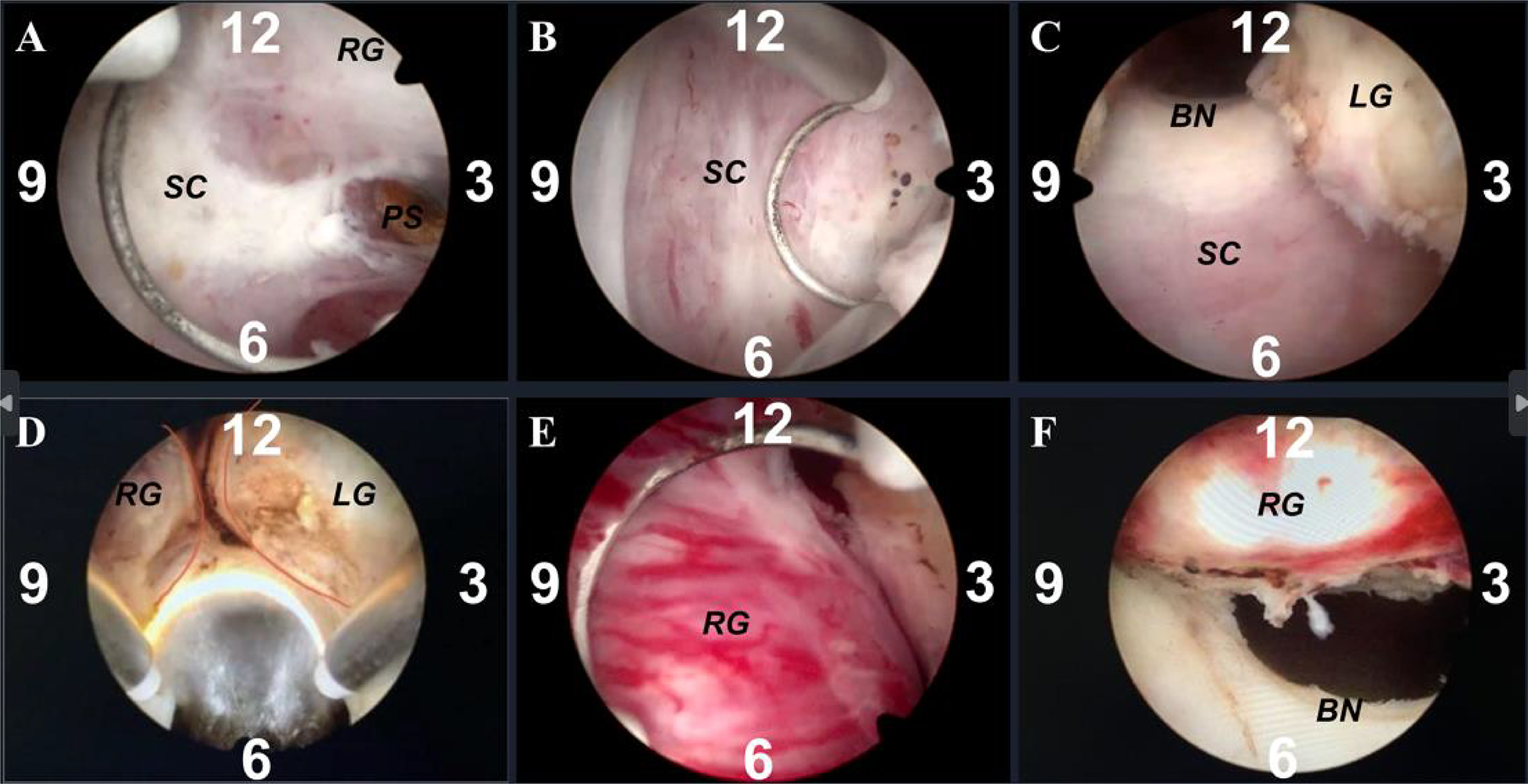 Surgical procedures of 
MPKERP. (A) Surgical capsule exploration; (B) Enucleation of glands on both 
sides from 3 to 9 o’clock in the lower part; (C) Enucleation of the middle gland; 
(D) Sector resection of the 12 o’clock glands; (E) cut residual distal urethral 
mucosa from 12 to 3 and 9 o’clock in the upper part; (F) Enucleation of lateral 
hyperplastic glands. Abbreviations: MPKERP, Modified Plasmakinetic Enucleation 
and Resection of the Prostate by three glands; SC, surgical capsule; BN, bladder 
neck; RG, right gland lobe; LG, left gland lobe; PS, prostate stone.