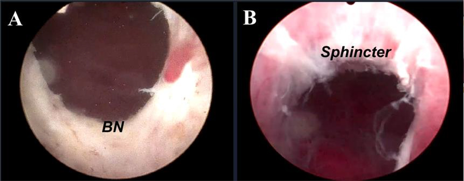 Enucleation based on the 
surgical capsule. (A) Complete enucleation of the hyperplastic glands and the 
wound surface of the prostatic fossa was smooth; (B) The sphincter was 
well-protected.