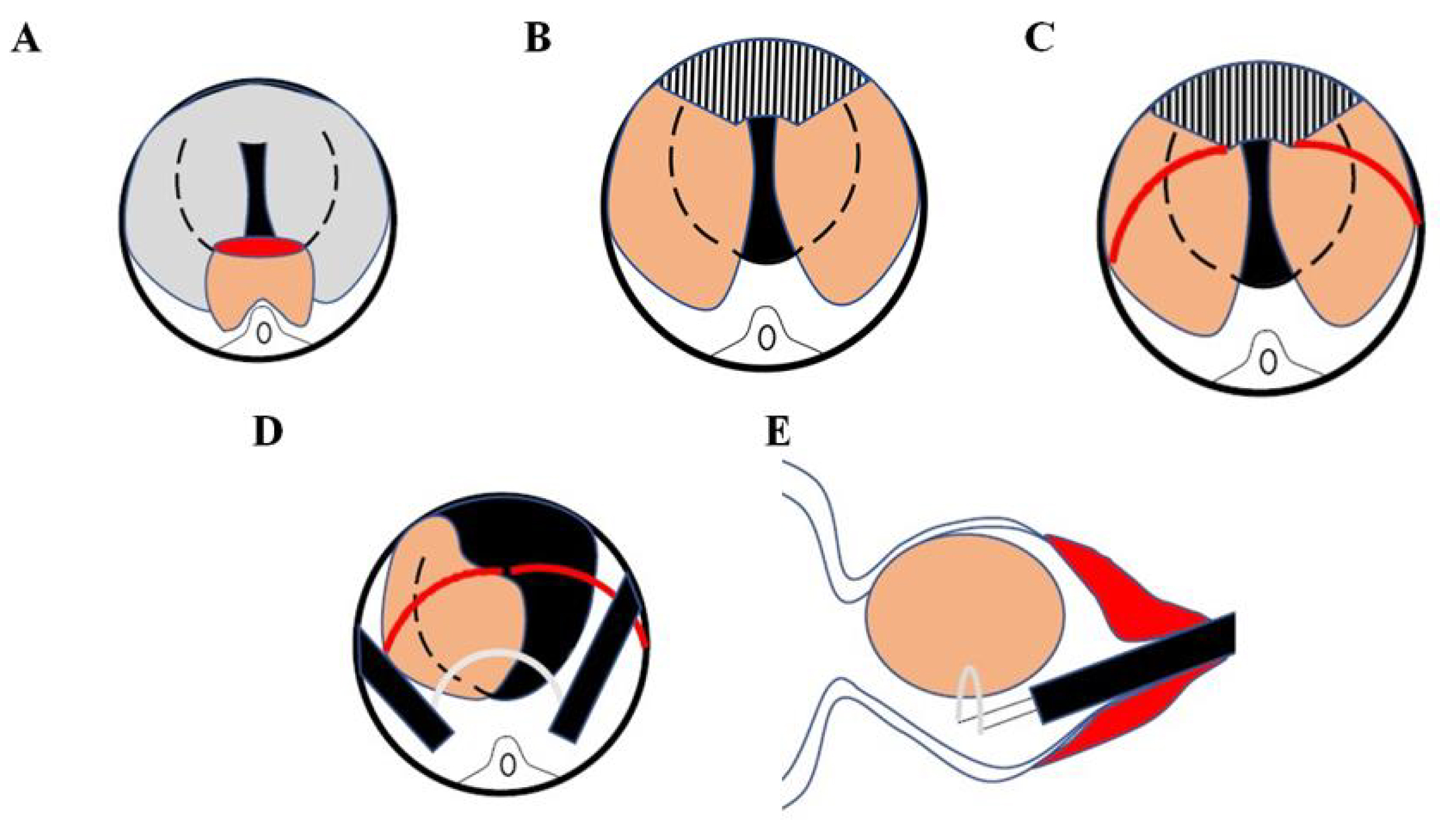 MPKERP design concept. (A) 
6 o’clock thin and wide resection was performed, which significantly reduced the 
pushing resistance of the central gland lobe and indirectly reduced the strength 
and angle of enucleation of the scope rod; (B) We enucleated the glands on both 
sides along the surgical capsule from 3 to 9 o’clock in the lower part, then made 
a sector resection at 12 o’clock; (C) The urethral mucosa was cut off at the red 
lines to protect the external urethral sphincter and reduce the incidence of 
urinary incontinence; (D,E) The lateral lobes were continuously enucleated 
medially to the bladder neck and left a little tissue traction on the left and 
right lateral lobes at 1 and 11 o’clock of the lithotomy position, followed by 
adjusting the direction of the electrical cutting ring and reducing injury to the 
external urethral sphincter.