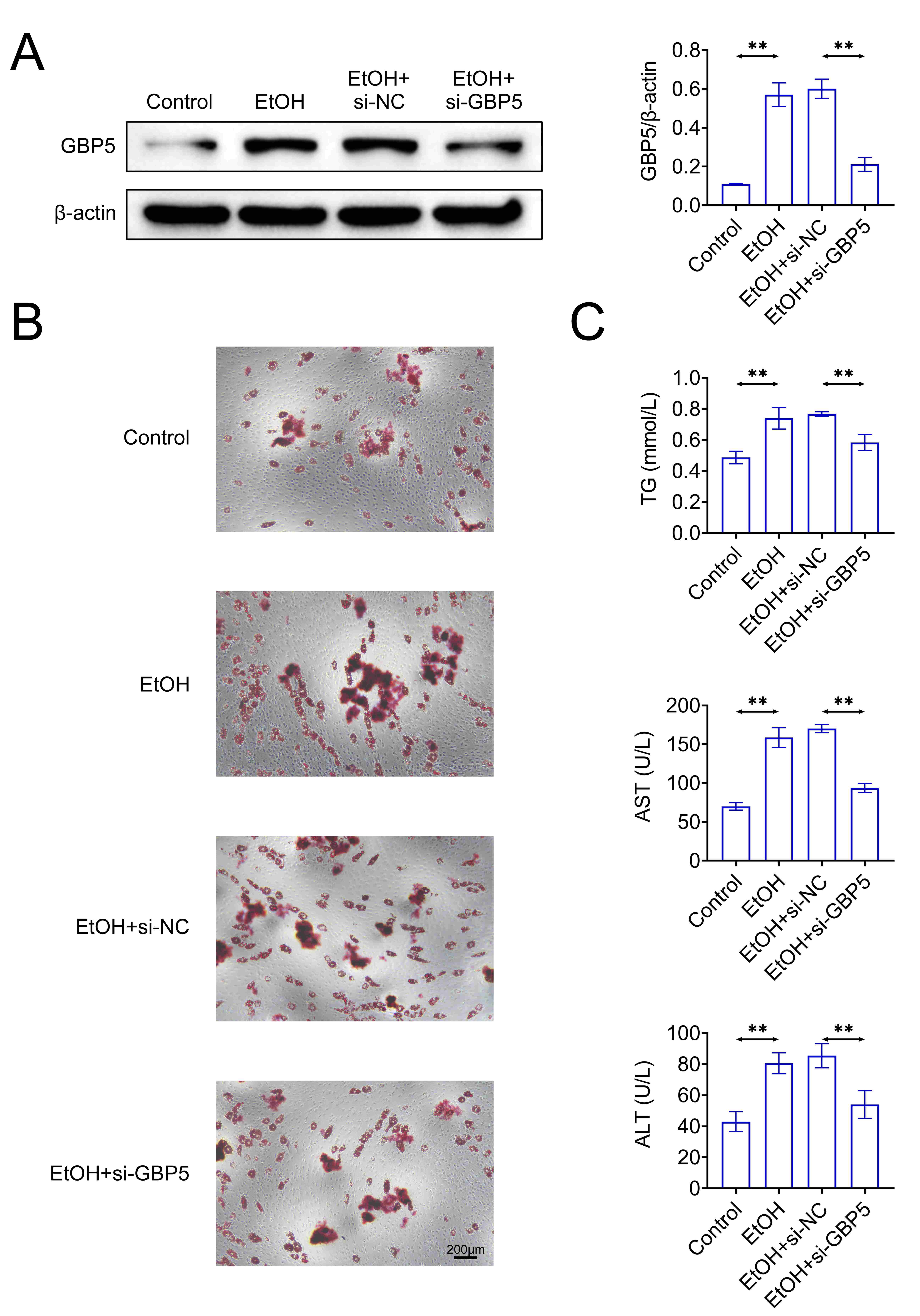 Knockdown of Guanylate
binding protein 5 (GBP5) suppressed Ethyl Alcohol (EtOH)-induced lipid
accumulation. Groups were divided into Control, EtOH, EtOH + si-NC and EtOH +
si-GBP5 groups. (A) GBP5 protein expression was examined through western blot.
(B) The lipid accumulation level was confirmed through Oil Red O staining assay. (C) The Triglyceride (TG), aspartate aminotransferases
(AST), and alanine aminotransferases (ALT) levels were measured through the
corresponding commercial kits. **p < 0.01. si-GBP5: siRNAs
used to target GBP5; si-NC: siRNAs used to a negative control.