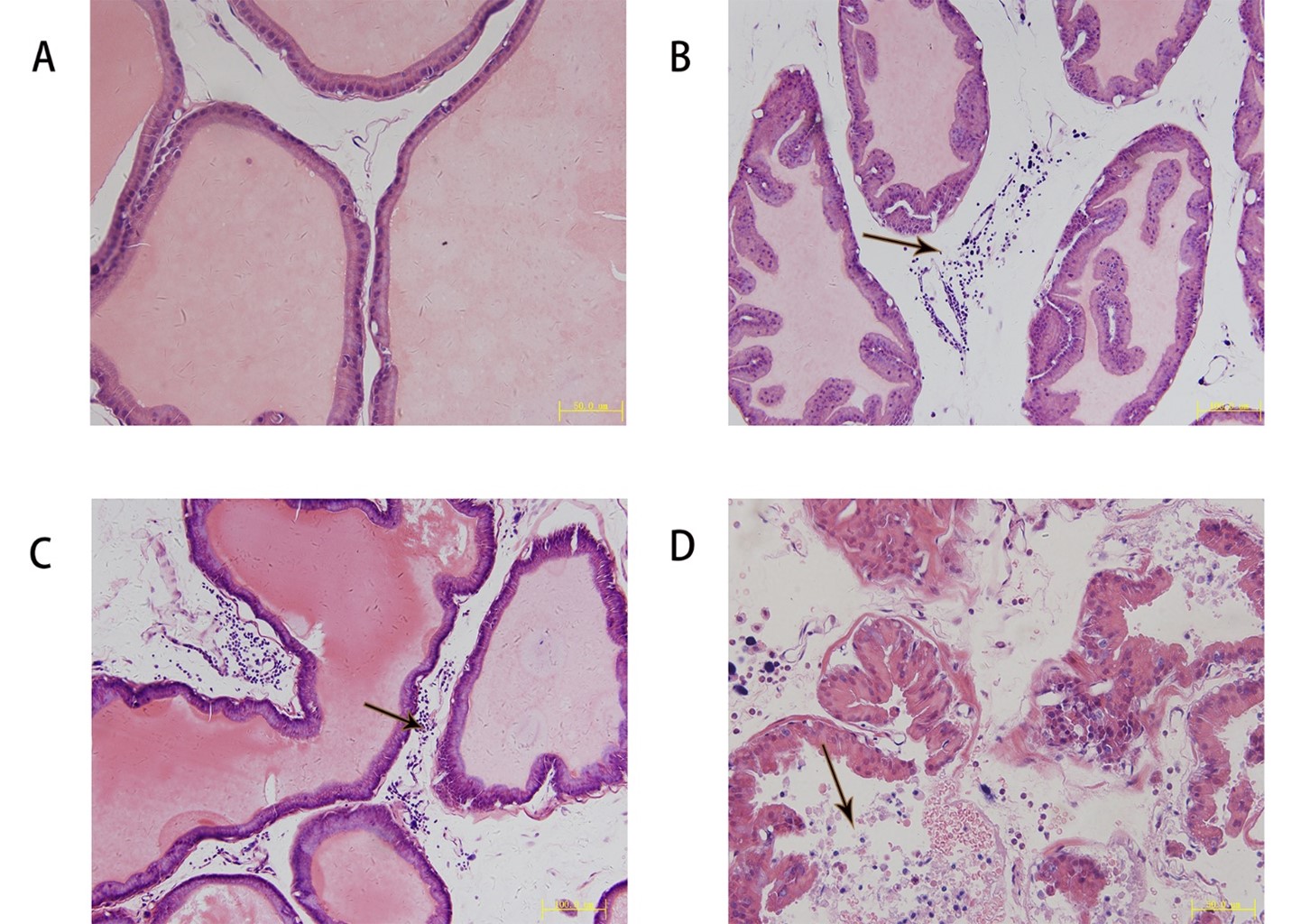 Results of HE staining of 
the prostate tissue from different groups of rats (scale bar: 50 
µm). (A) No inflammatory cells infiltration was seen in the 
prostate tissue of the control rats. (B) Lymphocytes were visible in the prostate 
tissue from the rat model of chronic nonbacterial prostatitis (CNP) at 45 days 
after modeling. (C) Edema was more obvious in the CNP rat model, with large 
numbers of lymphocytes at 60 days after modeling. (D) A large number of 
lymphocytes and mast cells were found in the CNP rat model, with a few 
neutrophils and plasma cells at 90 days. The black arrows indicate lymphocytes. 
The glandular cavity was expanded and collagen fibers were proliferated. Bar = 50 
µm.