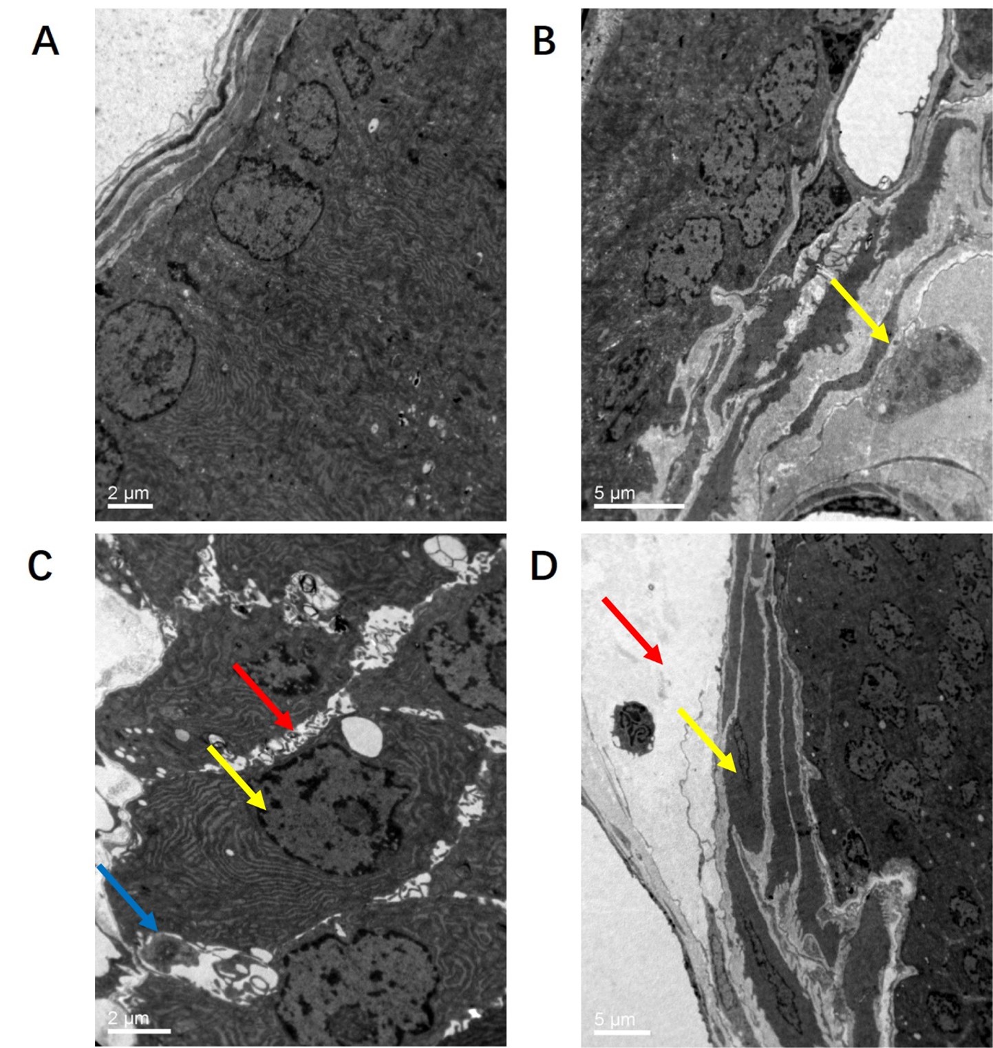 Prostate tissues from 
different groups of rats as observed under transmission electron microscopy. (A) 
The structure of the prostate was normal in the control group. (B) Mast cells 
were observed at 45 days after modeling. The yellow arrow indicates mast cells. 
(C) Widened intercellular space (the red arrow) of the epithelium along with 
lymphocytes (the blue arrow) and macrophages (the yellow arrow) were seen at 60 
days after modeling. (D) Fibrosis (the yellow arrow) and edema (the red arrow) 
were found in the Prostate interstitial at 90 days after modeling.