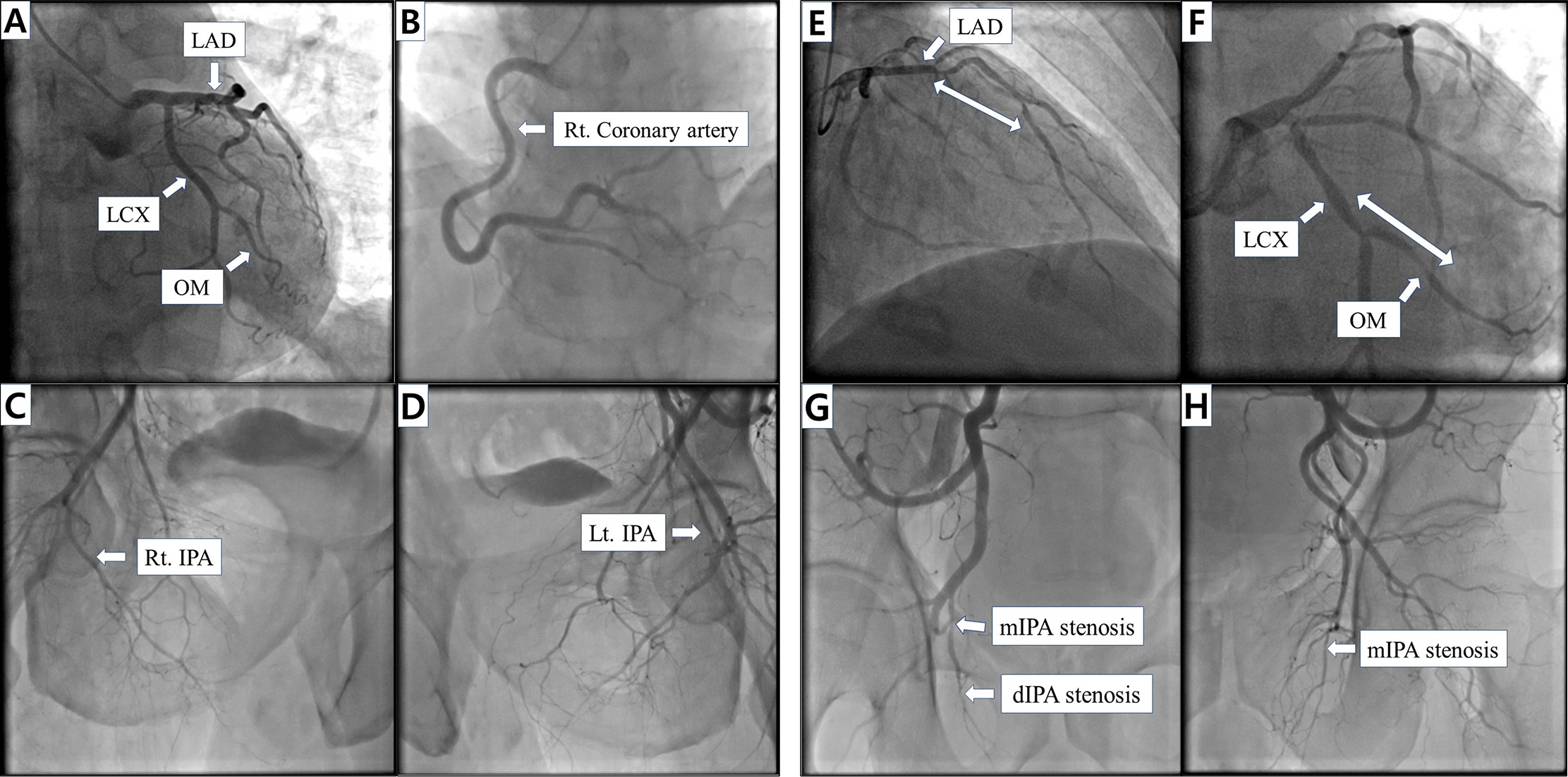 Angiographic findings in coronary arteries and II-IPA. A–D is from one patient in Group I, and E–H is from one patient in Group II.
The two-way arrow indicates the location and length of the stenosis. A: normal
CAG showing Lt. coronary artery, B: normal CAG showing Rt. coronary artery, C:
normal PA showing Rt. II-IPA, D: normal PA showing Lt. II-IPA: E, stenosis of LAD
(DS = 85) in CAG: F, stenosis of LCX OM branch (DS = 90) in CAG: G, stenosis of
mIPA (DS = 54) and dIPA (DS = 85) in Rt. IPA: H, stenosis of mIPA (DS = 19) in
Lt. IPA. The DS was measured by the QCA method. CAG: coronary angiography; dIPA:
distal internal pudendal artery; DS: diameter stenosis; II-IPA: internal
iliac-internal pudendal artery; LAD: left anterior descending artery; Lt.: left;
LCX: left circumflex artery; mIPA: middle internal pudendal artery; OM: obtuse
marginal artery; QCA method: quantitative coronary angiographic method; Rt.:
right.