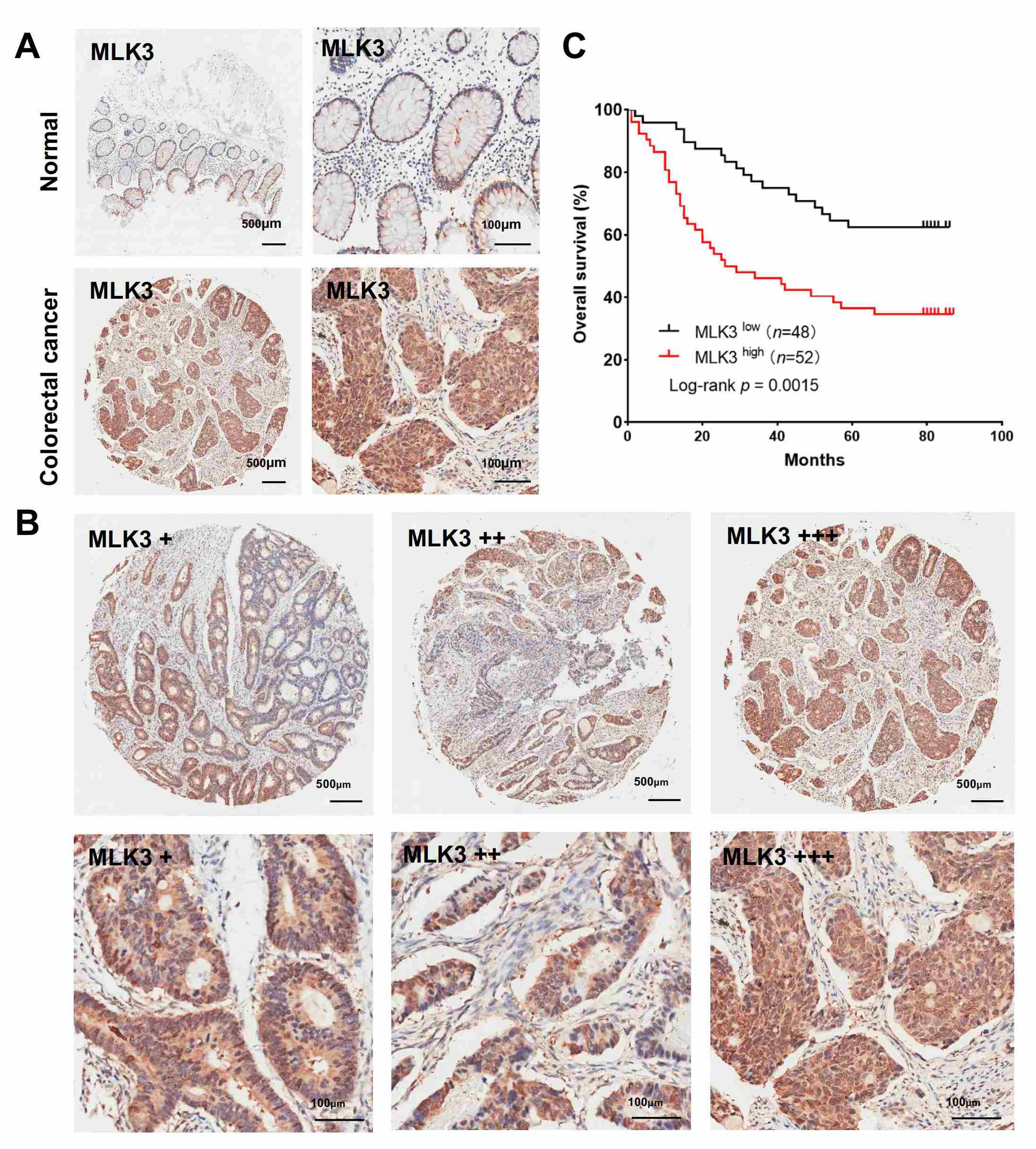 Immunohistochemical 
staining of MLK3 in CRC specimens. (A) Representative images of 
MLK3 expression in CRC samples and normal tissues. (B) Representative 
images of MLK3 expression with various CRC status (scale bar, 500 
µm and 100 µm). (C) MLK3 expression and overall survival 
rate. MLK3, mixed-lineage protein kinase 3.