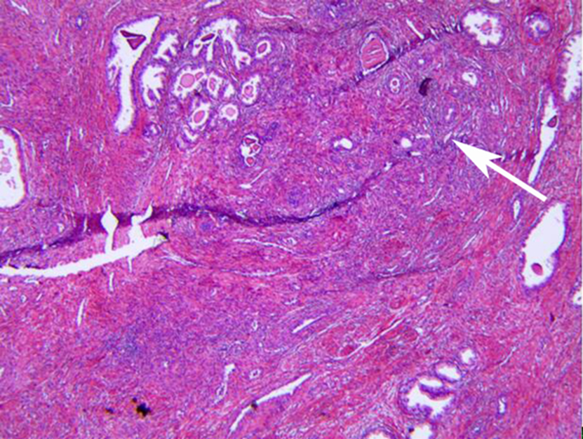 Representative pathology
image of prostate cancer. The arrow indicates the tumor on gross histological
slides.