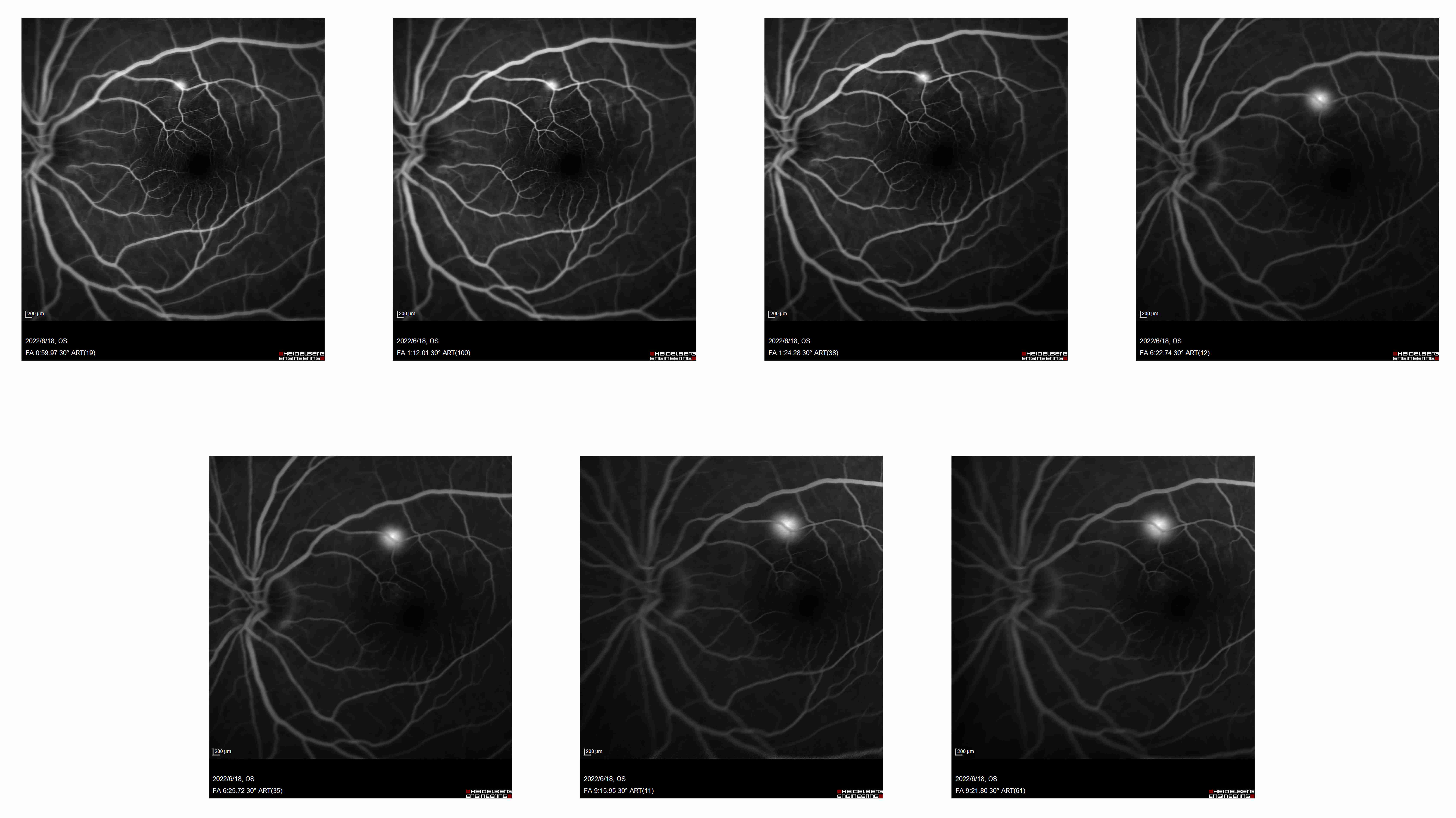High blood flow signals in
the corresponding areas of fundus fluorescein angiography (FAA) early
fluorescence and/or leakage in OCTA.