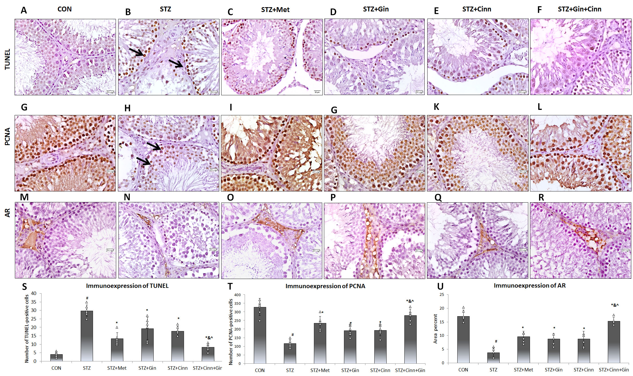 Effect of Cinnamon and ginger extracts on TUNEL, PCNA,
AR testicular immunoexpression. Immunoexpression of TUNEL (A–F), PCNA (G–L),
AR (M–R) in the testis of the study groups is presented. TUNEL + ve cells
(arrow) are more prevalent while the PCNA + ve cells (arrow) are less prevalent
in STZ group. Semi-quantitative assessment of this expression is presented
(S–U). TUNEL: terminal deoxynucleotidyl transferase dUTP-mediated nick-end
labeling, TUNEL assay. PCNA: proliferating cell nuclear antigen; AR: androgen
receptor; STZ: streptozotocin; Met: metformin; Gin: ginger; Cinn: Cinnamon. N =
6. Mean ± SD is presented. ANOVA test followed by Bonforoni
post-hoc test was used. #: significant versus control; *:
significant versus STZ + Met; &: significant versus STZ + Gin;
^: significant versus STZ + Cinn.