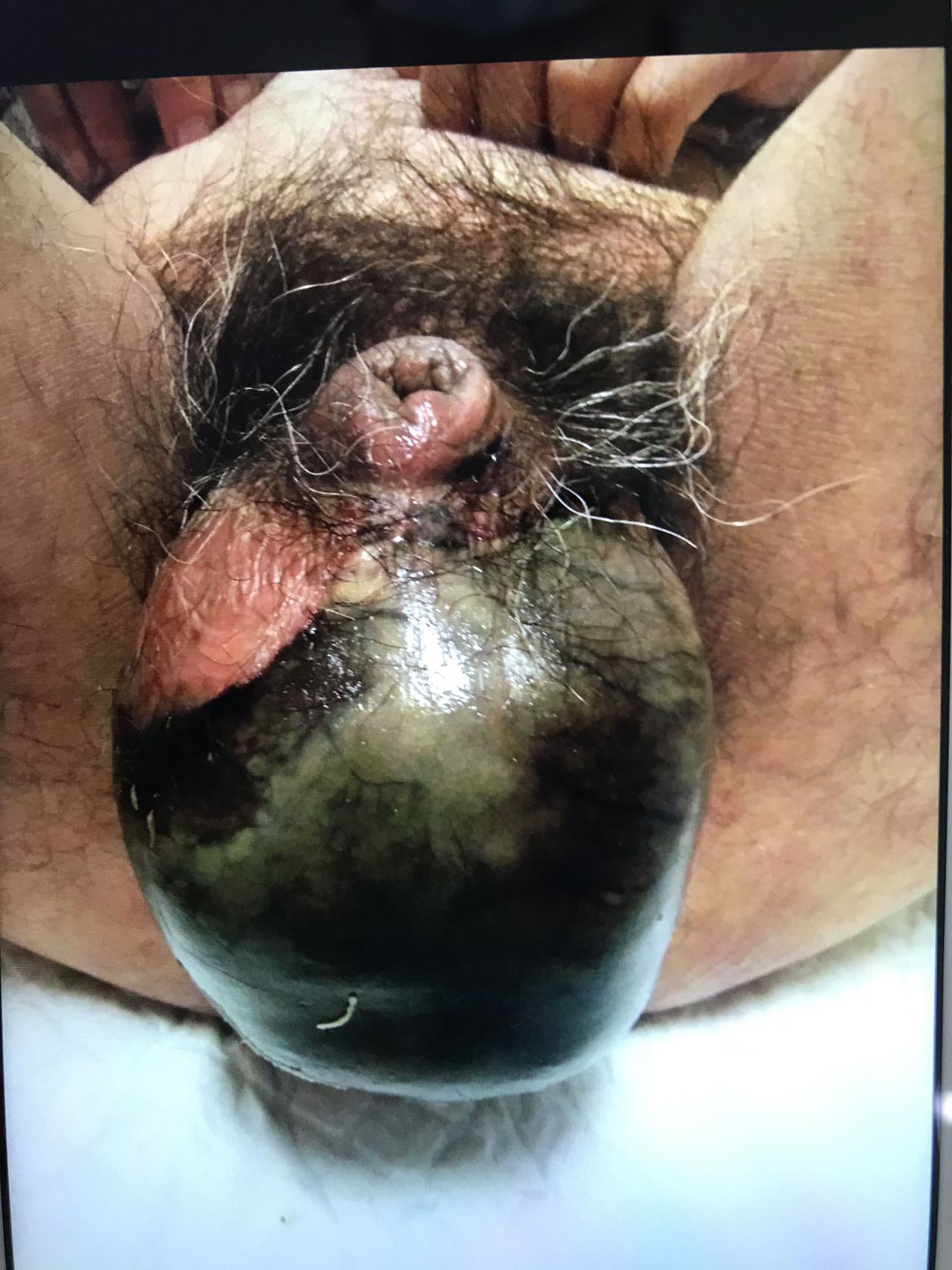 Typical scrotal gangrene, scrotal swelling, necrosis and
blackening of scrotal skin, accompanied by a foul odor. Images taken
before the first debridement surgery (25 February 2021).