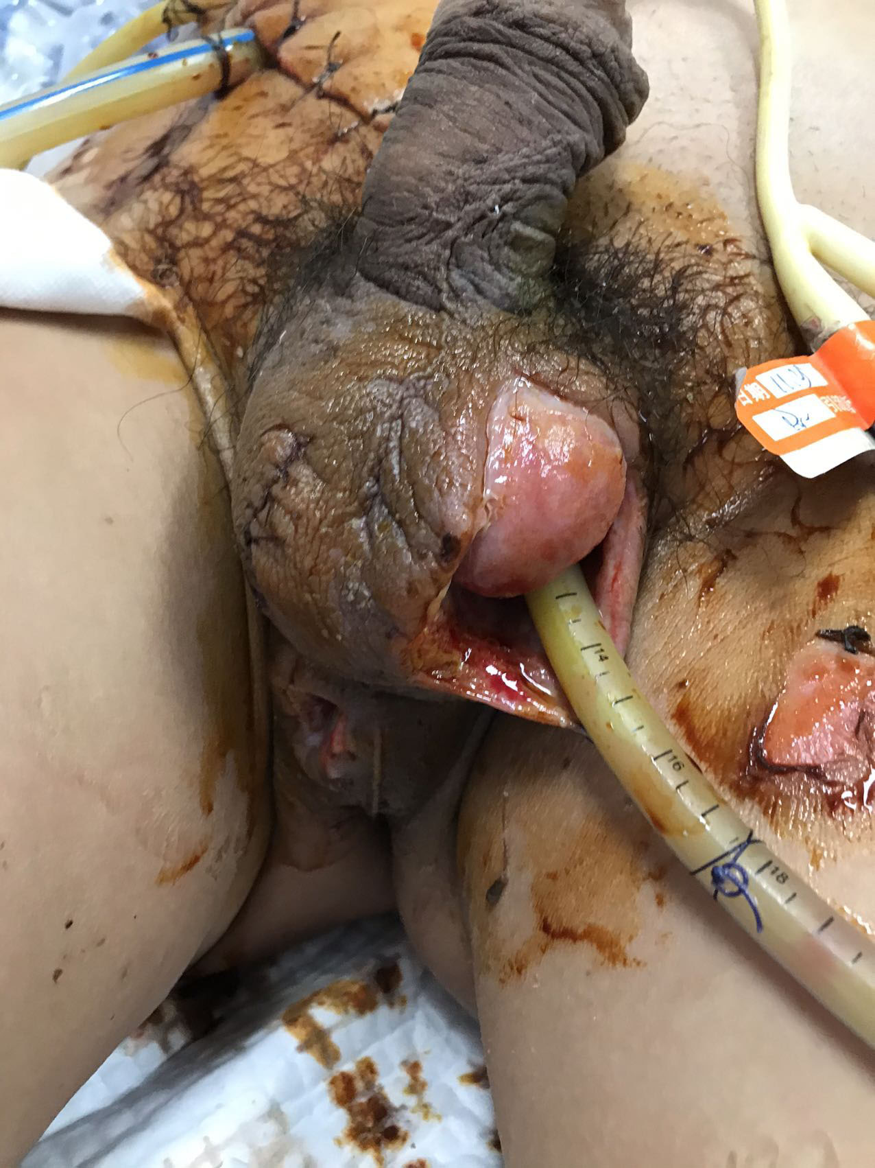 Surgical debridement, exposing the wound surface and drainage
of pus through drainage tubes (26 November 2020).