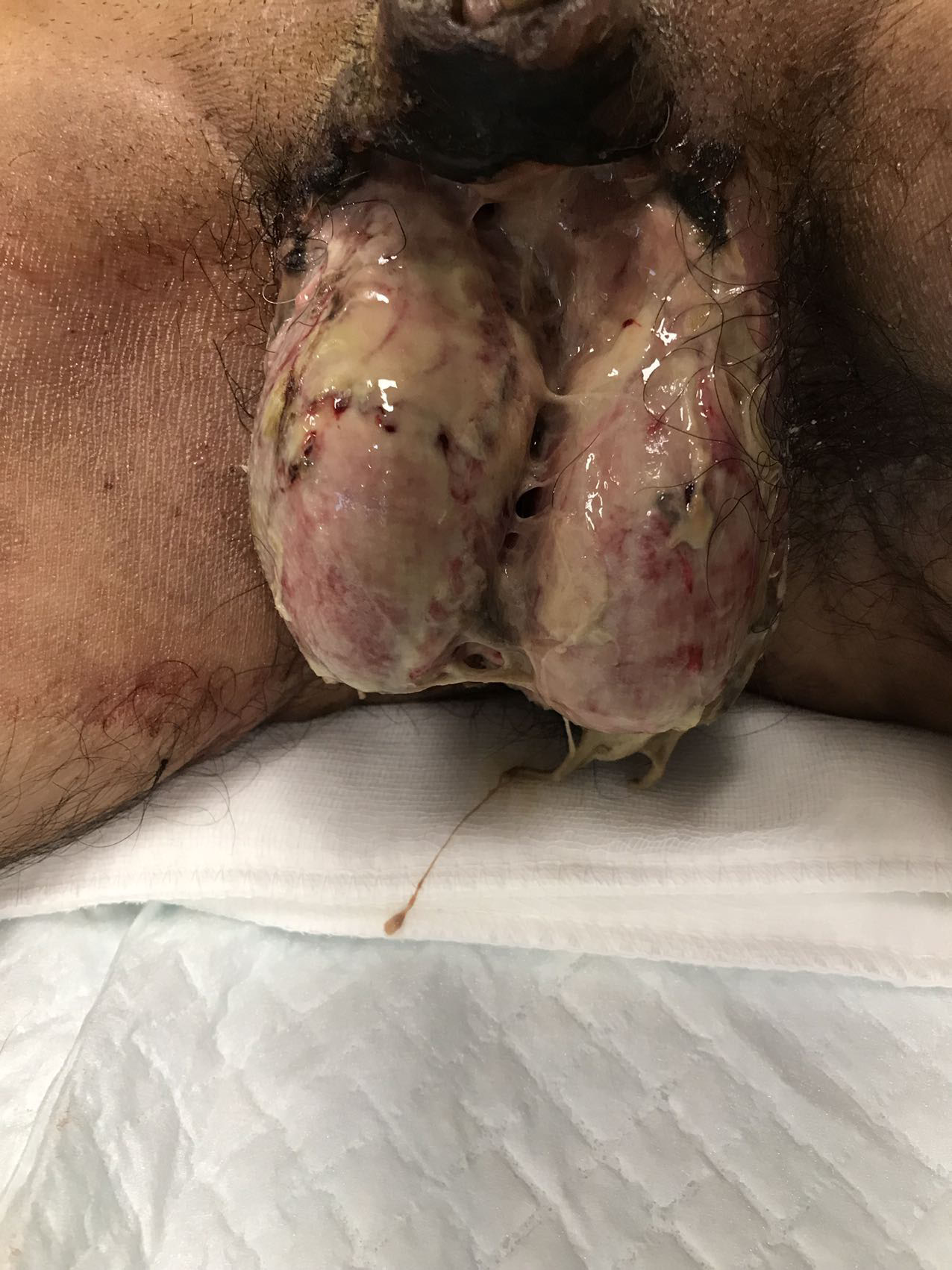 After the first debridement, the necrotic skin of the scrotum
was removed, and both testicles were exposed. The wound surface was
filled with a large amount of purulent secretions (26 February 2021).