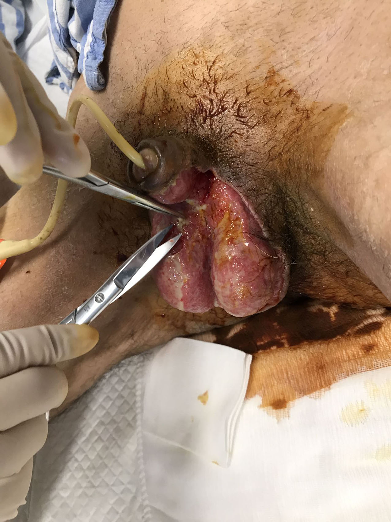 After surgery, there is still necrotic tissue on the wound
surface, and conservative sharp instrument debridement is performed on the wound
surface (12 March 2021).