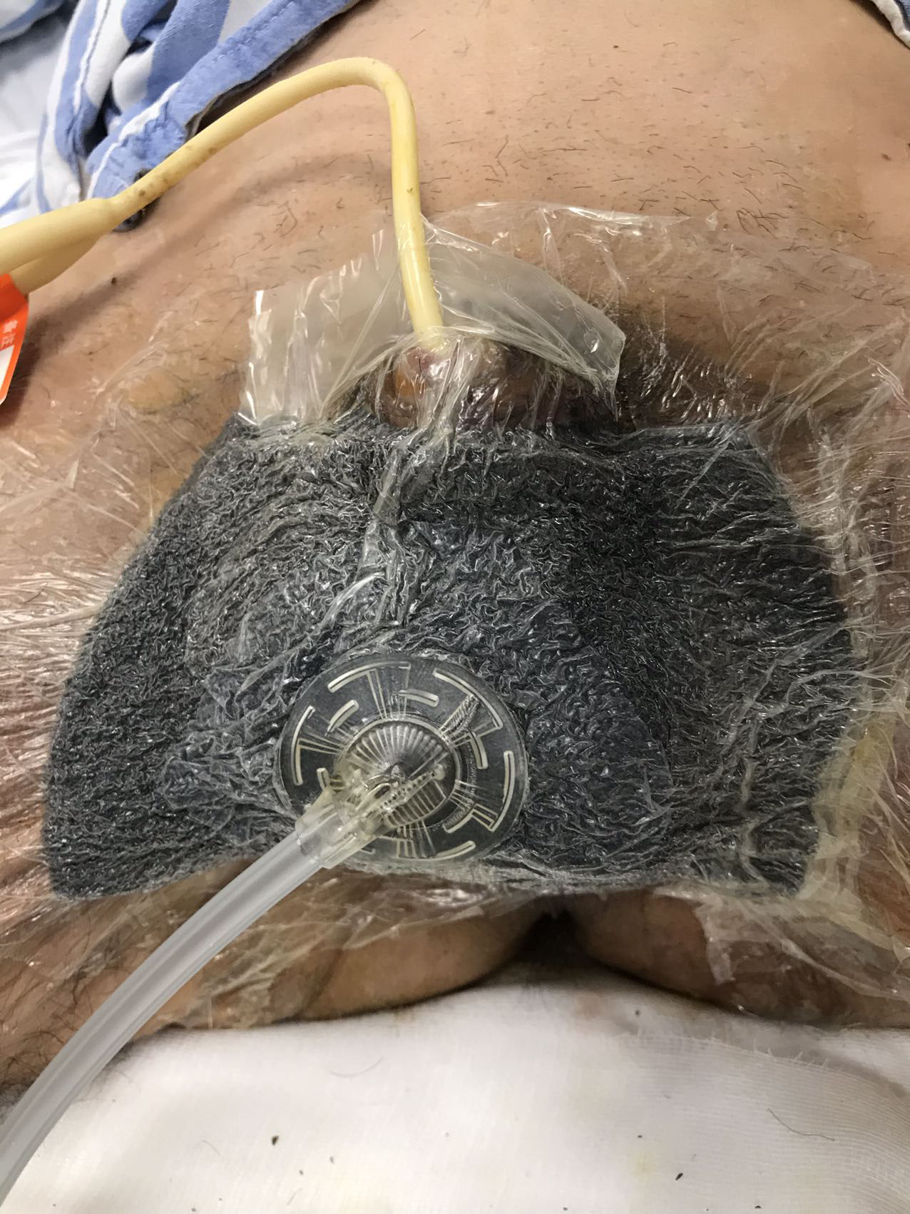 Negative pressure wound therapy (NPWT) was applied to the wound
to remove necrotic tissue and exudate, reducing the bacterial load (15 March
2021).