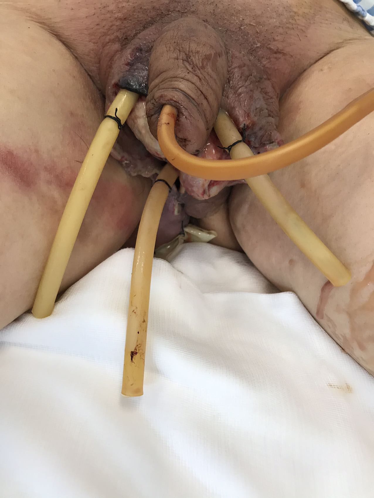 Image after multiple conservative sharp instrument debridement
(29 April 2021).
