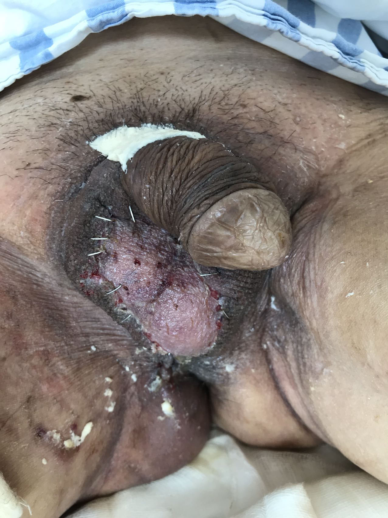 Image of the skin graft restored blood circulation after scrotal
transplantation (21 May 2021).
