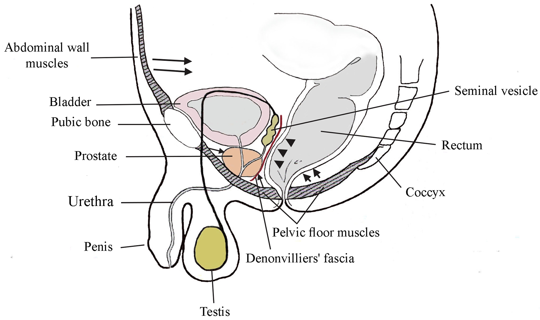Functional-anatomic arrangement of the human rectum and
prostate that enables defecation-caused prostate drainage. Arrowheads, the inner
rectal pressure generated by transiting fecal matter; Arrow, external compression
of the rectum and prostate, due to contraction of the abdominal wall and pelvic
floor muscles.