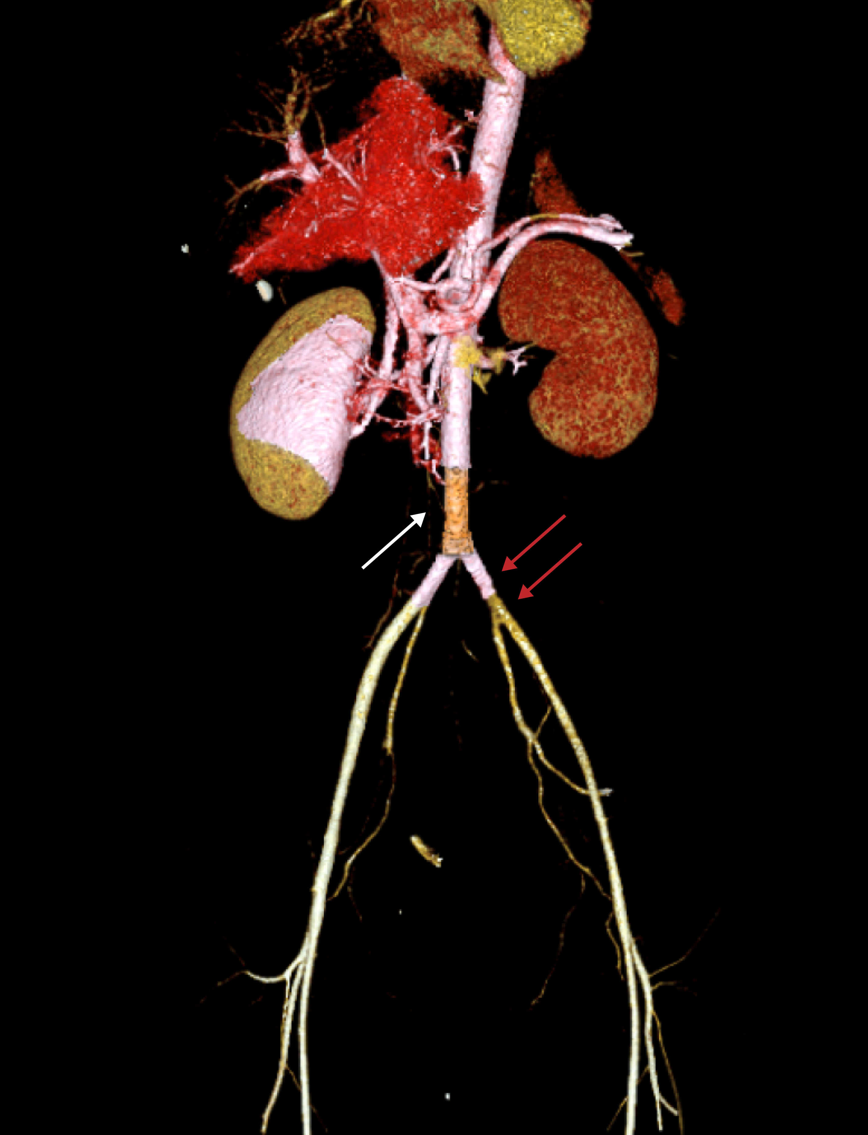 Computed tomography angiography (CTA) demonstrates a covered
abdominal aortic stent and left iliac artery stenosis. The white arrow represents
a covered abdominal aortic stent; the red arrows represent left iliac artery
stenosis.