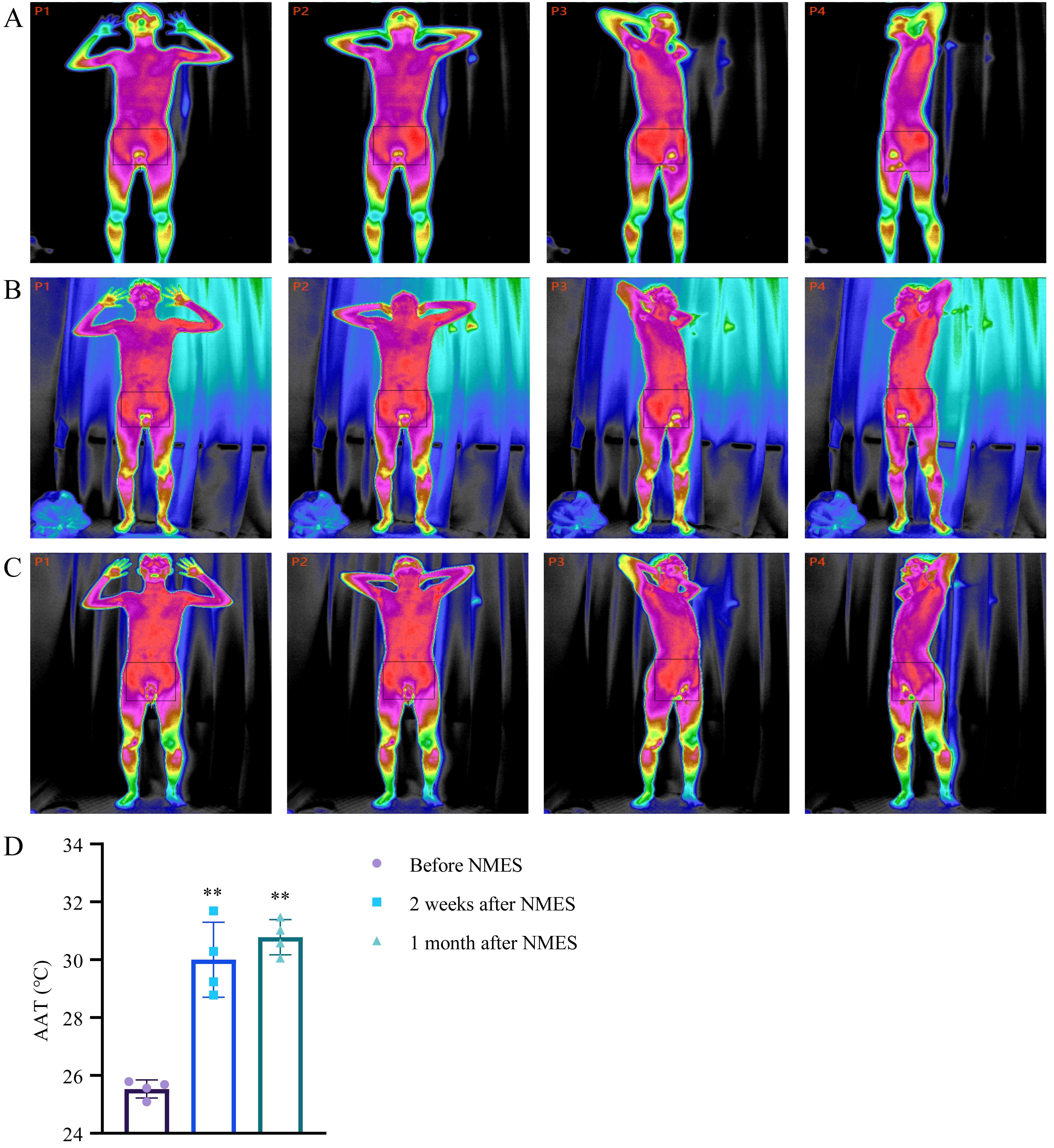 The thermal images and temperature changes before and after NMES
treatment. (A). The thermal images at different body positions before NMES
treatment. (B). The thermal images at different body positions two weeks after
NMES treatment. (C). Thermal images at different body positions one month after
NMES treatment. (D). NMES treatment increased the AAT (areas in
the rectangular boxes) of the pelvic floor muscle. AAT, average absolute
temperature; NMES, neuromuscular electrical stimulation.