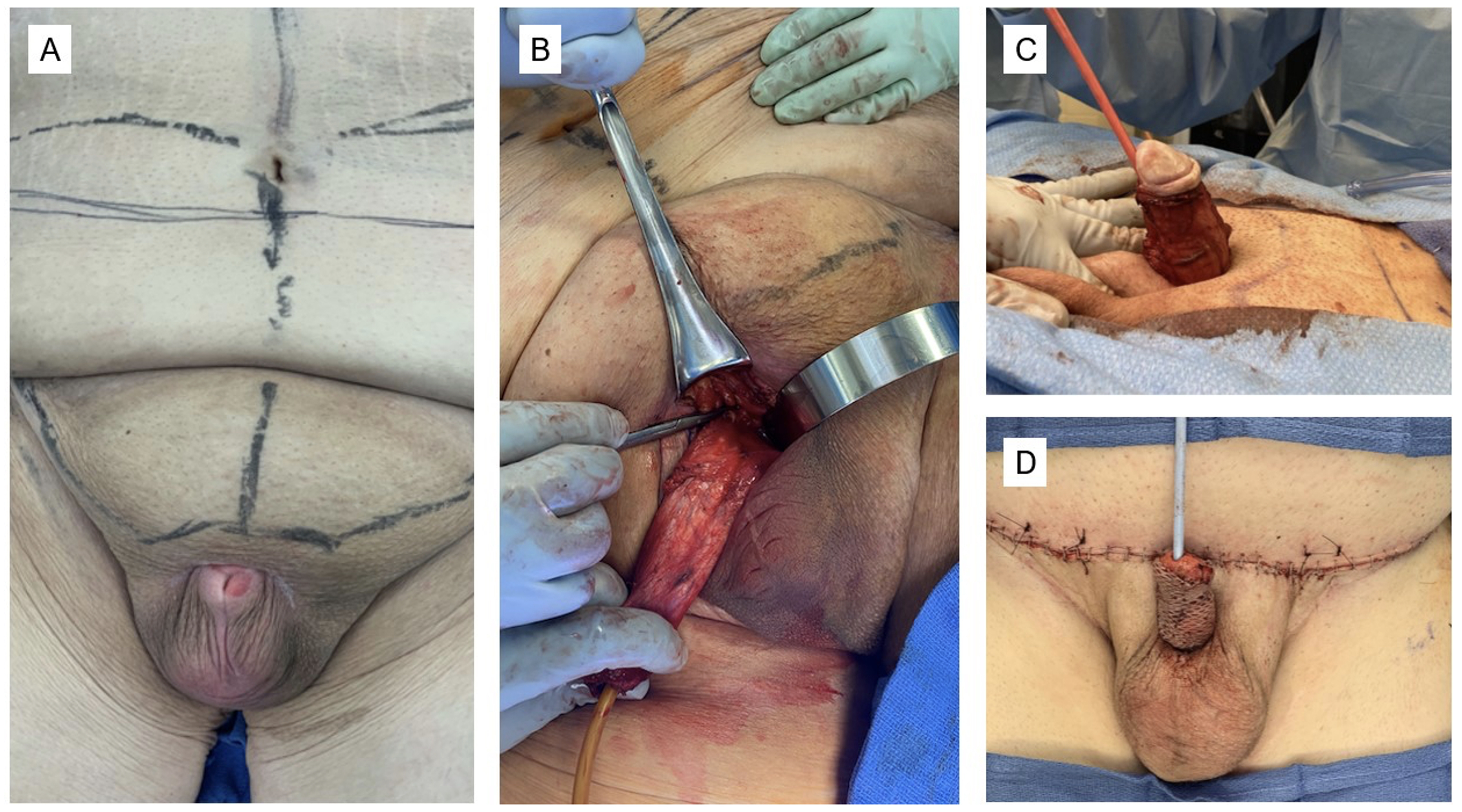 Surgical repair. (A) Typical presentation of a patient with
AABP prior to surgery. The patient’s skin has been marked (in the preoperative
holding area) for the panniculectomy and for the skin graft harvested from the
pannus. (B,C) The patient’s penis has been degloved during surgical repair. The
poor tissue has been excised, and the penis is no longer buried by the
escutcheon. The full length of the penis can be assessed and measured to
determine the size of graft required for penile coverage. (D) A meshed
split-thickness skin graft was used for coverage of the penile shaft.