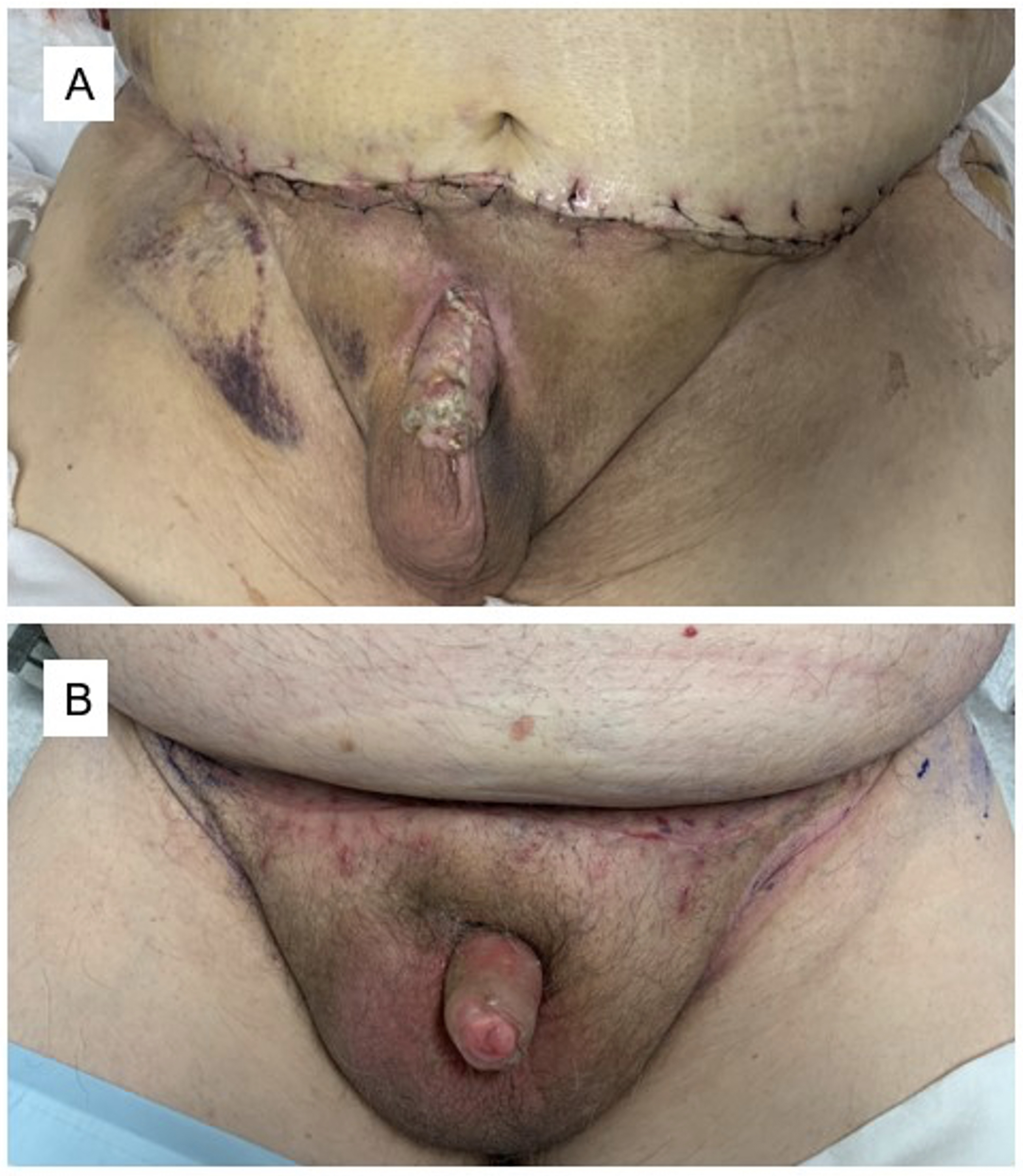 Postoperative healing. (A) The appearance of the
repaired buried penis at 2 weeks postoperation. The incisions are healing
appropriately. (B) The appearance of the repaired buried penis at 7 weeks
postoperation. The incisions are healed, and the meshed appearance of the graft
is less visible.