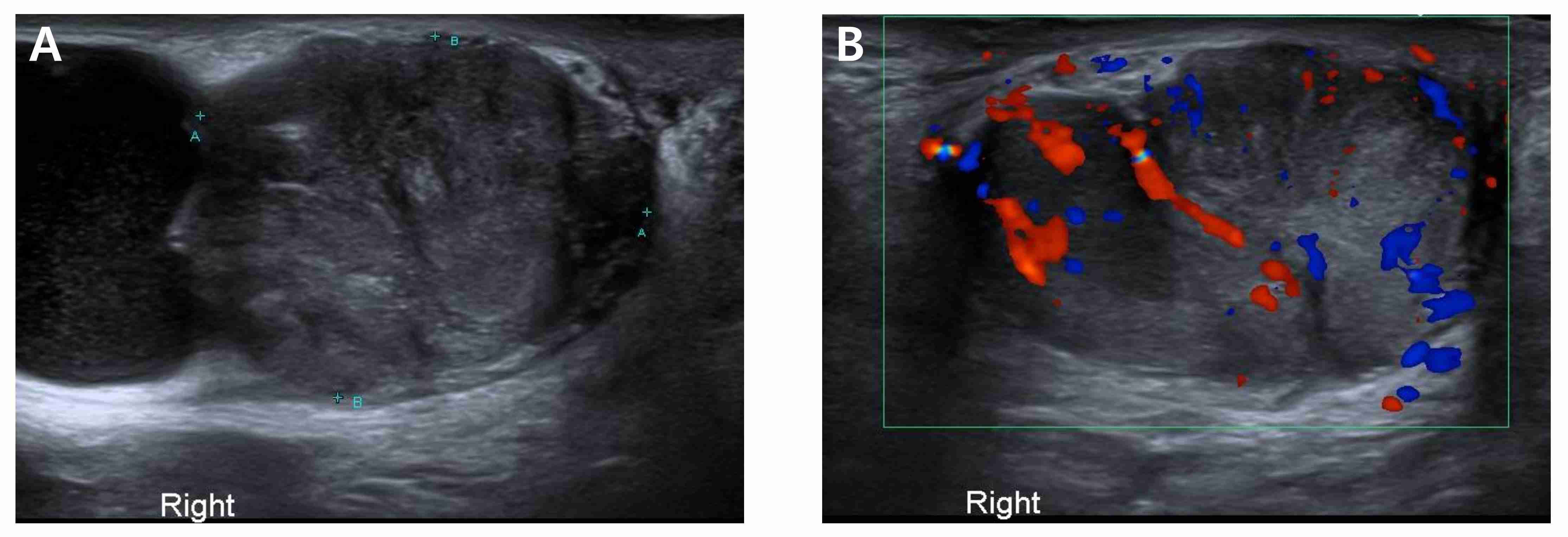 Ultrasound scan images. (A) Ultrasound scanning for right
testicular mass. (B) Ultrasound scanning with color doppler mode for right
testicular mass.