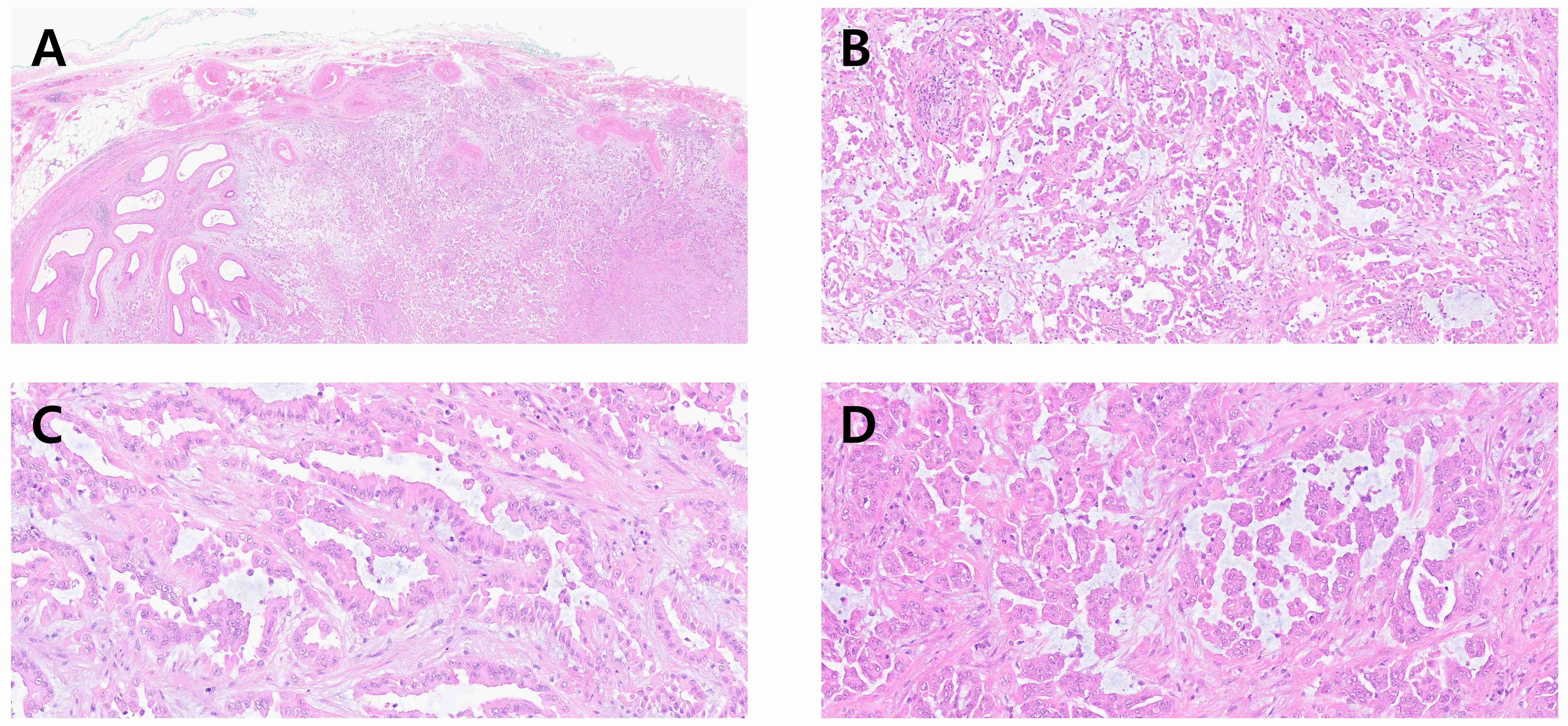 Representative pathological images. (A) Tumor cells infiltrating
paratesticular soft tissue (hematoxylin and eosin staining (H&E), ×40).
(B) Epithelial cells with eosinophilic cytoplasm showing micropapillary growth
pattern (H&E, ×200). (C,D) Large polygonal epithelioid cells with fair
amounts of cytoplasm and round to oval nuclei showing tubular and micropapillary
architectural patterns (H&E, ×400).