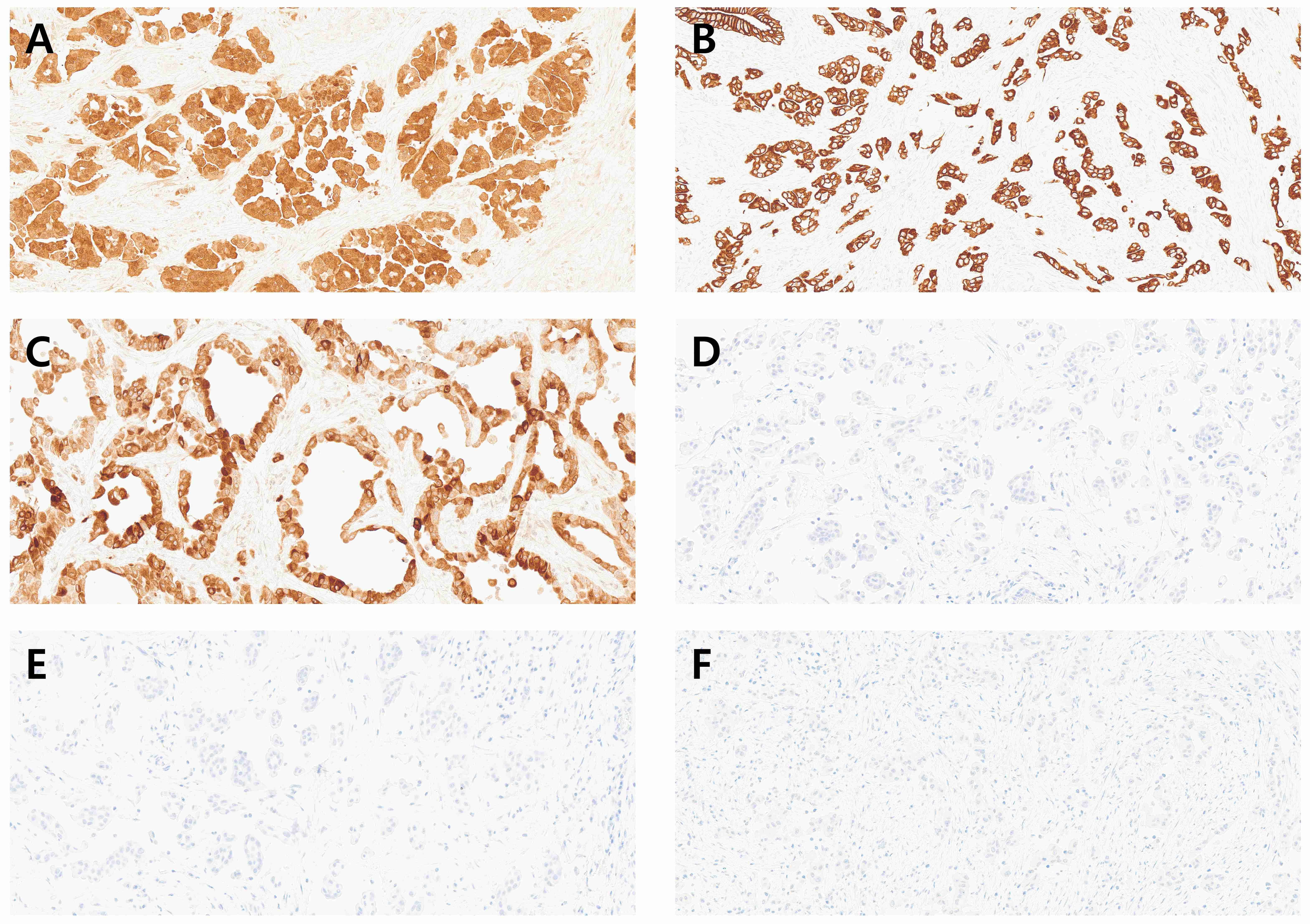 Representative immunohistochemical images. Positive for (A)
calretinin, (B) CK 7 and (C) EMA Negative for (D) CEA, (E) CK 20 and (F) inhibin
(immunohistochemistry staining, ×400).