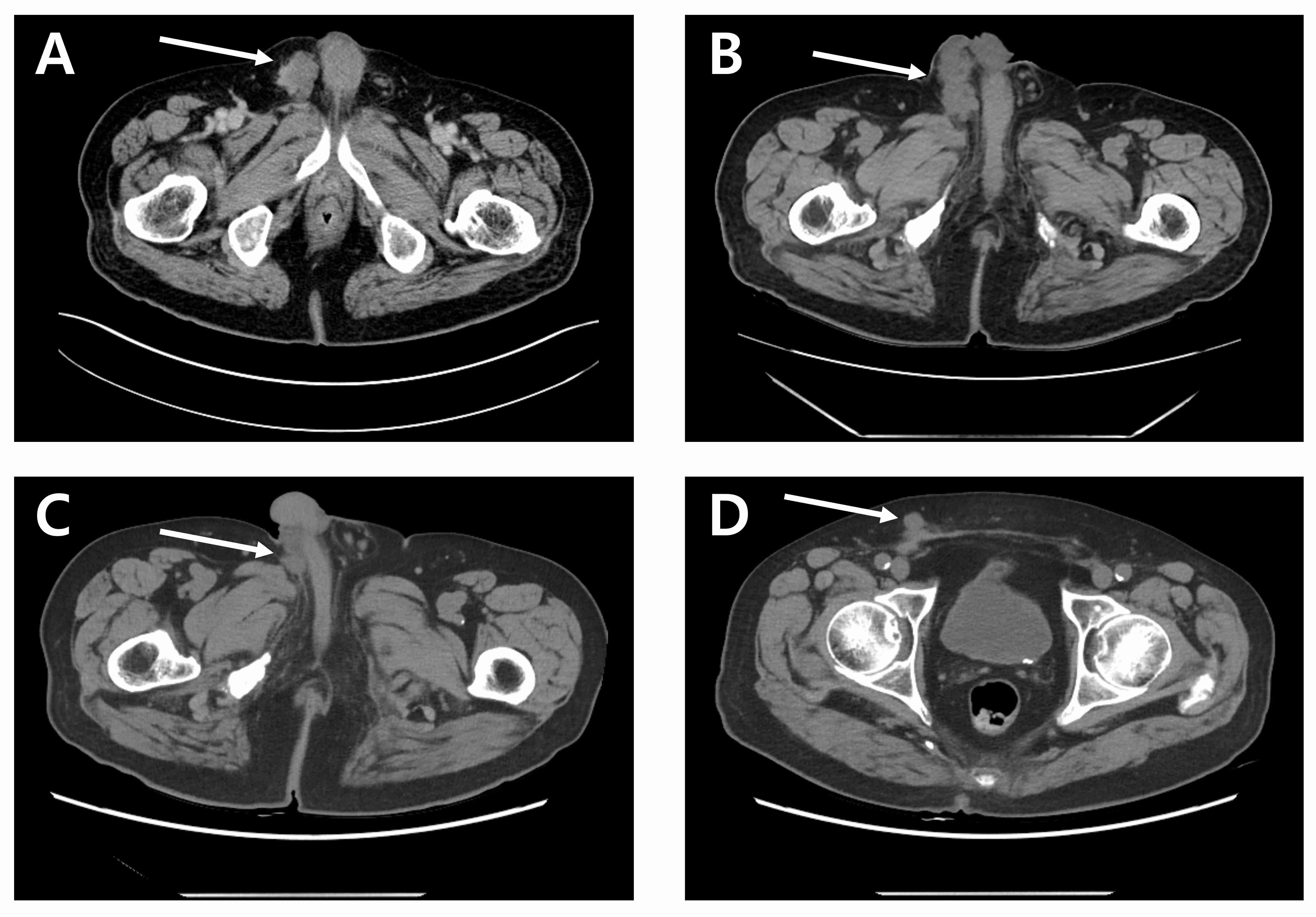 Computed tomography scan images. Recurrences of paratesticular
malignant mesothelioma in (A) October 2021, (B) April 2022, (C) November 2022 and
(D) February 2023.