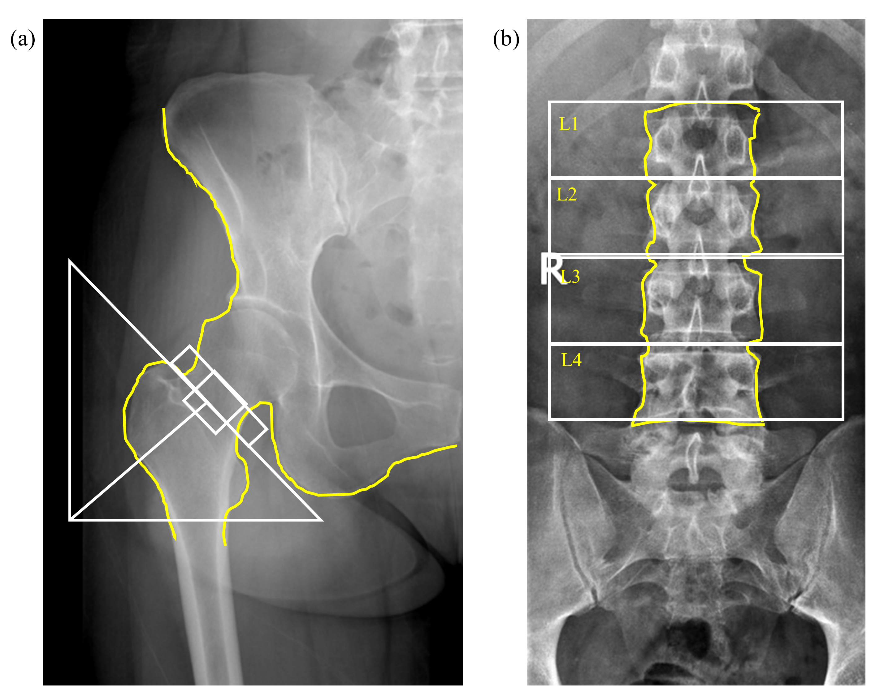 Bone mineral density location at X-ray at the (a)
femoral neck and (b) lumbar spine 1–4.