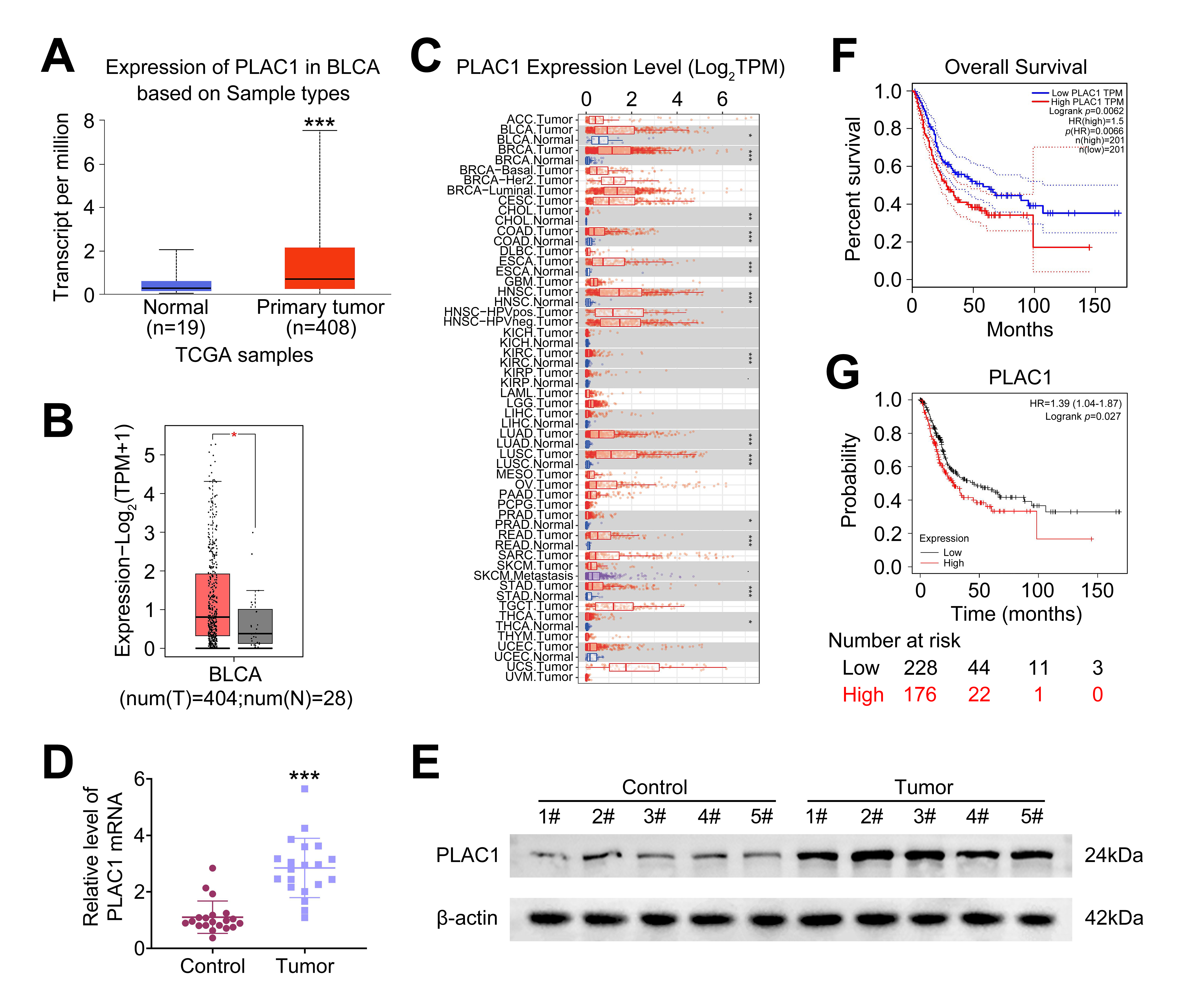 Expression of PLAC1 in BCas and its association
with the prognosis of patients with BCa. (A) Differential expression analysis
reveals PLAC1 transcripts per million (TPM) in tumor and normal tissues in the
UALCAN dataset. (B) GEPIA displays PLAC1 expression differences between tumor and
normal tissues. (C) TIMER shows the differential expression of PLAC1 in tumor and
normal tissues. (D) qRT-PCR assays depict RNA expression levels of PLAC1 in
adjacent nontumor bladder tissues and BCa tissues. (E) Immunoblot analysis of
PLAC1 expression in 5 representative adjacent nontumor bladder tissues and BCa
tissues. (F) Kaplan-Meier survival curve illustrating the correlation between
PLAC1 expression and BCa prognosis. (G) Kaplan-Meier survival analysis
demonstrating the survival outcomes of BCa patients in relation to PLAC1
expression, as confirmed by the KMplot database. *p < 0.05,
**p < 0.01, ***p < 0.001. TPM: transcripts per million.