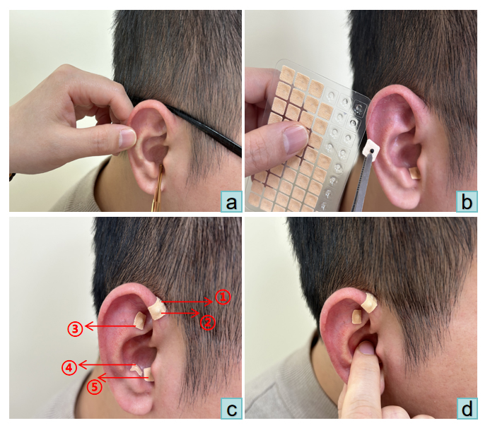 Diagram of the auricular pressure bean use. (a) detecting 
sensitive spots with an ear probe; (b) adhesive tape with Wang Bu Liuxing seeds 
to the ear acupoints; (c) selected points (external genitalia acupoints; 
sympathetic acupoints; Shenmen acupoints; subcortical acupoints; endocrine 
acupoints); (d) instruction the patient to apply pressure on selected acupoints.