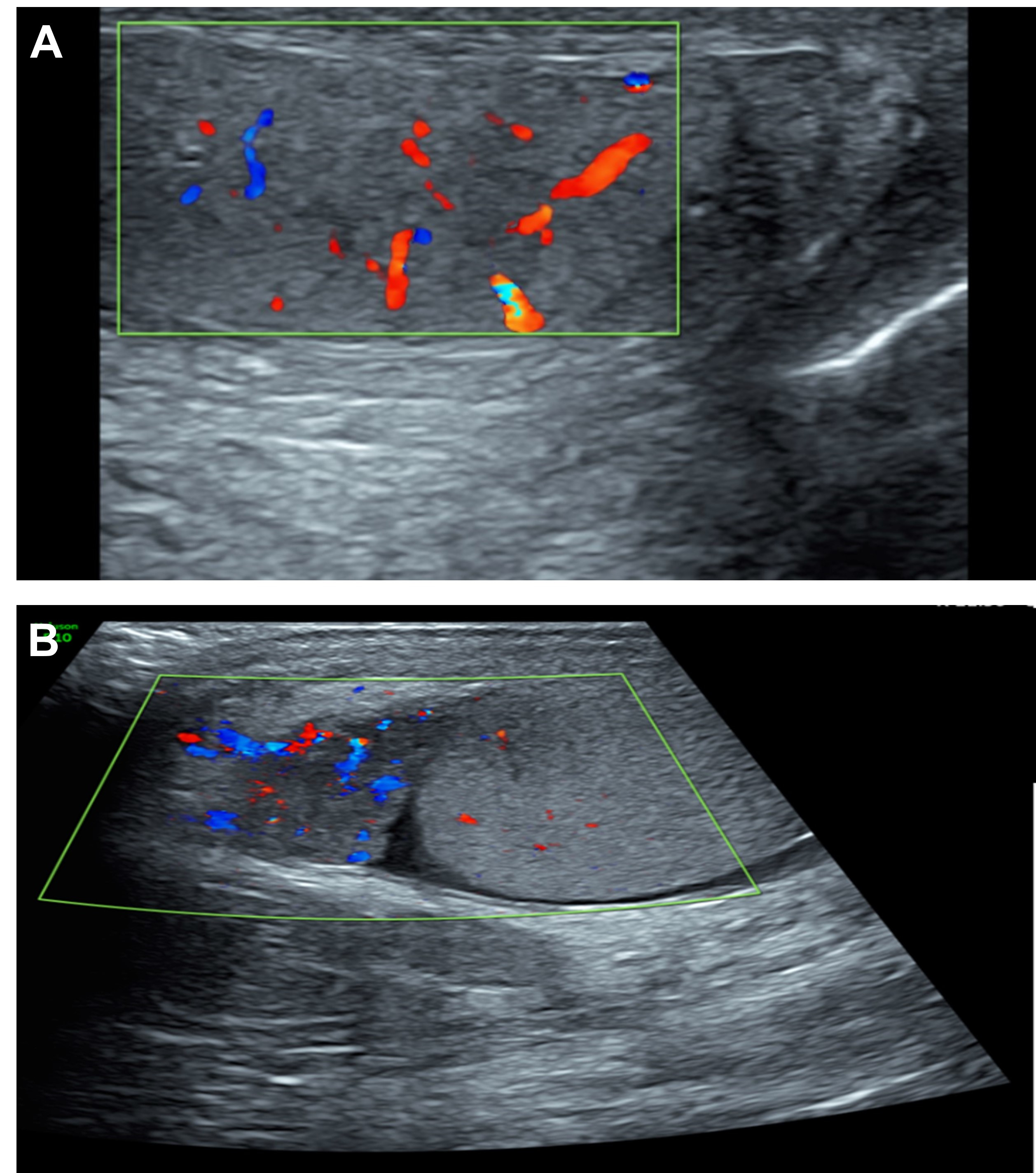 Representative scrotal ultrasonography image of a patient with
epididymo-orchitis. (A) Increased vascularity in both epididymis and testes, as
observed in 77.8% of the patients. (B) Increased vascularity in the epididymis,
as detected in 22.2% of the patients.