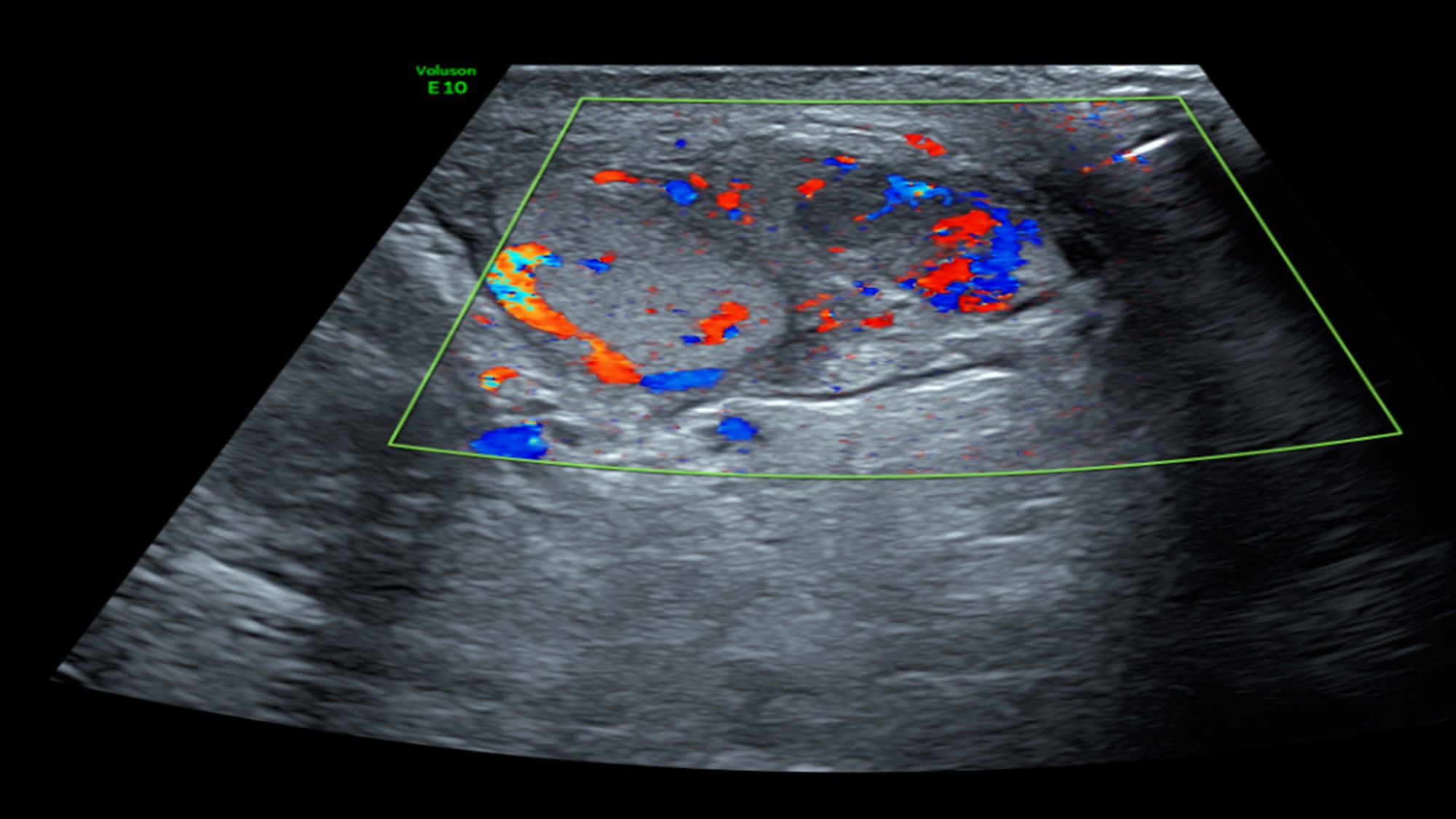 Scrotal ultrasonography showed left epididymitis with the
hypoechoic lesion as a complication of epididymo-orchitis in three (3.6%) of the
63 investigated patients.