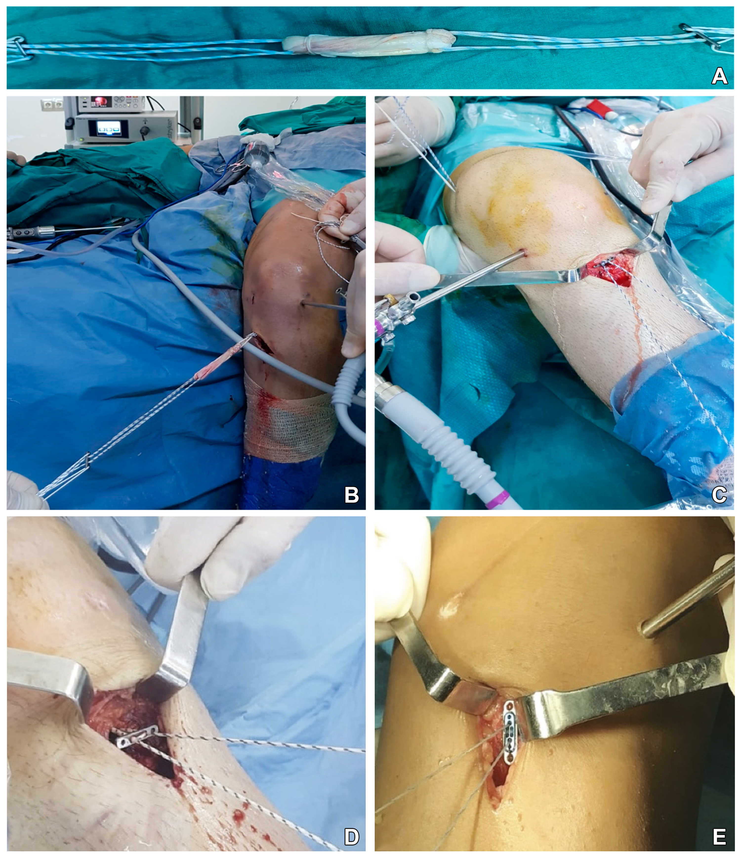 Modified all-inside anterior cruciate ligament reconstruction 
technique procedures. (A) Anatomical preparation and adjustable suspension 
fixation of a single bundled quadrupled ST tendon autograft, (B) insertion of the 
system prepared as ST tendon autograft into the knee, (C) fixation of the ST 
autograft into the tunnel on the tibial side, (D) The ST graft was securely 
placed in the tibial tunnel using Lift Loop and (E) fixation was performed using 
a combination of Ultrabutton and Xtendobutton.
