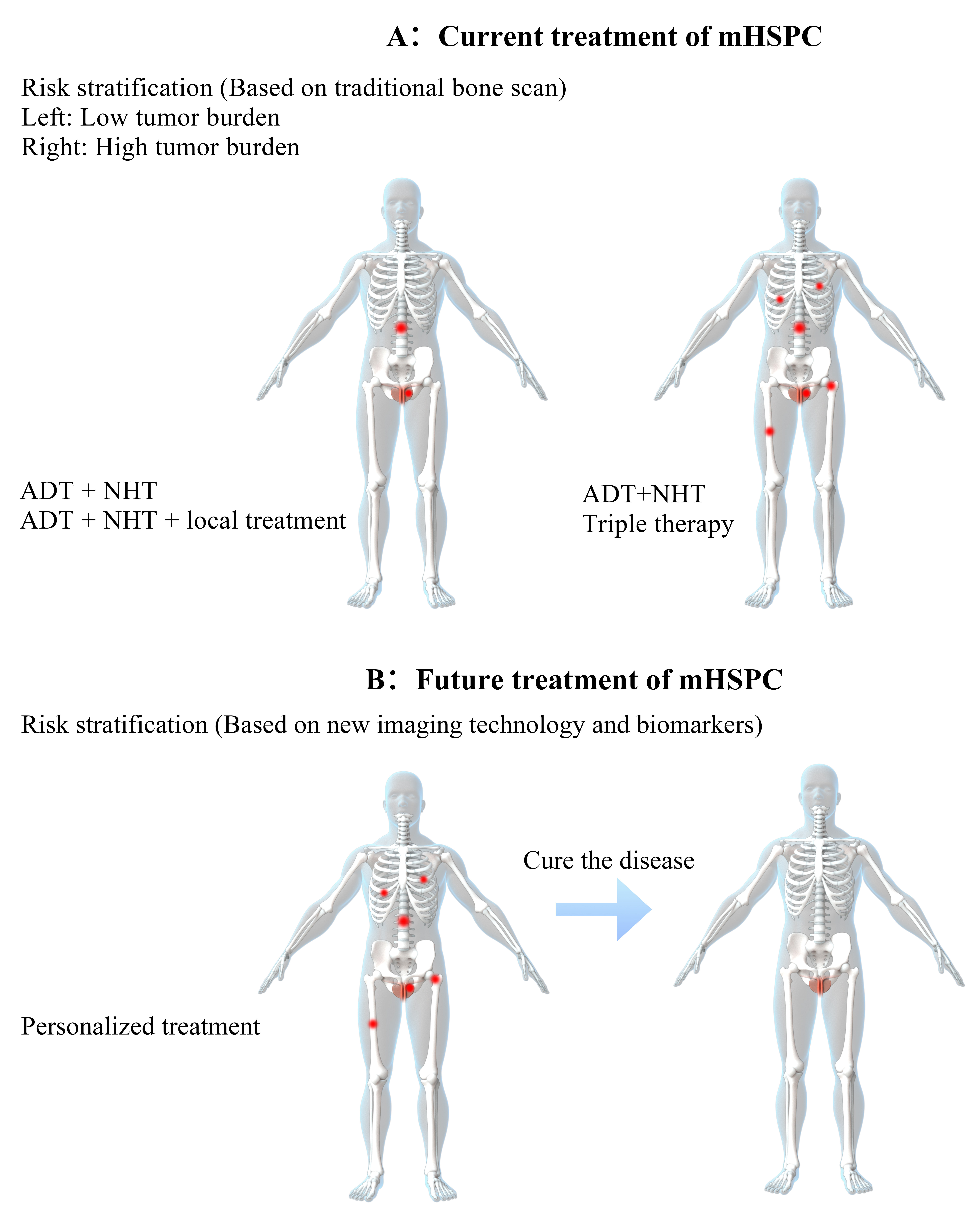 Current and further treatment regimens for mHSPC patients. (A) 
current treatment for mHSPC. Current treatment strategy for mHSPC is based on 
life expectancy and traditional imaging. For patients with long life expectancy 
and low metastatic burden, ADT + NHT and effective local treatment is 
recommended. For patients with long life expectancy and high metastatic burden, 
ADT + NHT is recommended, and triple therapy (ADT + chemotherapy + 
Abiraterone/Darolutamide) is also a suitable choice. For patients with short life 
expectancy, ADT + NHT is recommended. Drug’s side effects and patients’ quality 
of life should be considered during the treatment. Treatment escalation or 
treatment de-escalation may be discussed with patients based on treatment 
response. Long term follow-up and careful observation of treatment response and 
disease progress is important for mHSPC patients. (B) Further potential treatment 
for mHSPC. Advanced imaging technologies, useful biomarkers, novel drugs and drug 
combinations, new techniques in surgery and radiation, may lead to personalized 
treatment options for mHSPC patients. Treatment decision may be made based on 
life expectancy, new imaging evaluation and useful biomarkers. Treatment 
strategies including surgery, radiation and effective drug and drug combinations 
may help mHSPC patients to recover from this disease. mHSPC: Metastatic 
hormone-sensitive prostate cancer; ADT: Androgen deprivation therapy; NHT: new 
hormone therapy.