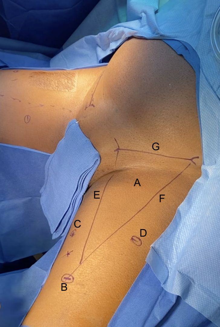 Incision outline in laparoscopic VEIL on left thigh. A 1.5 cm
incision was made approximately 2 cm below the apex of the femoral triangle (A)
to create a camera port (B). Medially and laterally to the camera port
(~6 cm), 2 operative ports were placed (C,D, respectively).
The borders of the femoral triangle are adductor longus muscle on the medial side
(E), sartorius muscle on the lateral side (F), and inguinal ligament (G).