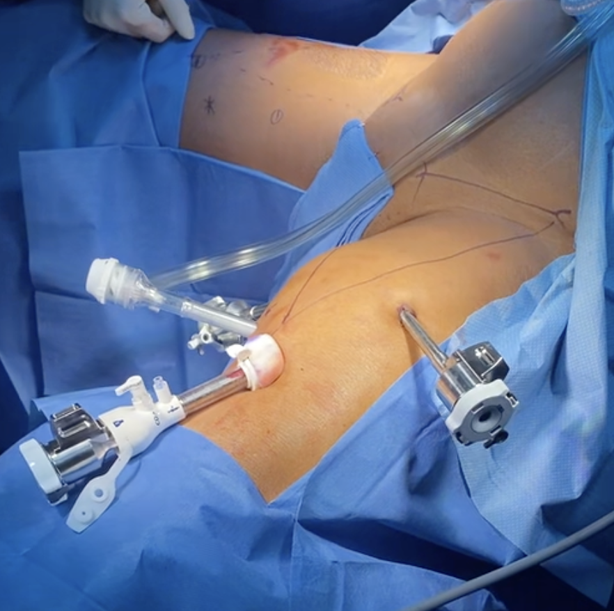 Robotic port placements in a patient undergoing robotic-VEIL.
The robotic camera port was placed 25 cm inferior to the middle of the inguinal
ligament. Two robotic ports were placed medially and laterally
(~8 cm) from the camera port and an assistant port placed between
the camera and medial robotic port.