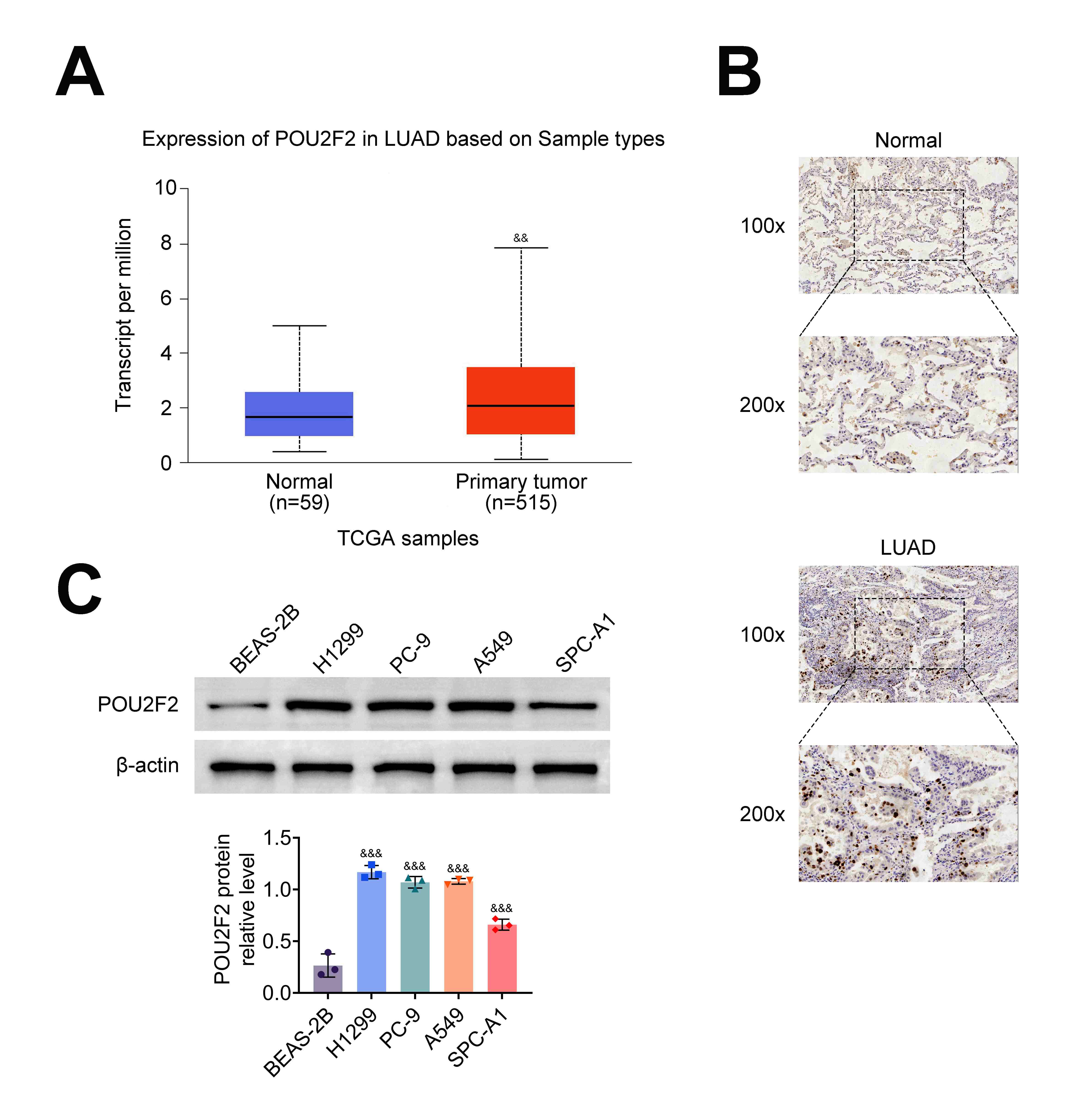 POU2F2 owned
higher expression in LUAD. (A) The expression of POU2F2 in LUAD tissues
and normal tissues was confirmed through the UALCAN online database
(http://ualcan.path.uab.edu/index.html).
(B) The POU2F2 protein expression was verified in Normal tissues and
LUAD tissues through IHC assay. (C) The protein expression of POU2F2 was
assessed in the LUAD cell lines (H1299,
PC-9, A549, SPC-A1) and normal lung epithelial cell line (BEAS-2B) through
western blot. &&p < 0.01, &&&p < 0.001.
LUAD: Lung adenocarcinoma; POU2F2: POU class 2 homeobox 2; UALCAN: A
Portal for Facilitating Tumor Subgroup Gene Expression and Survival Analyses;
IHC: Immunohistochemistry.