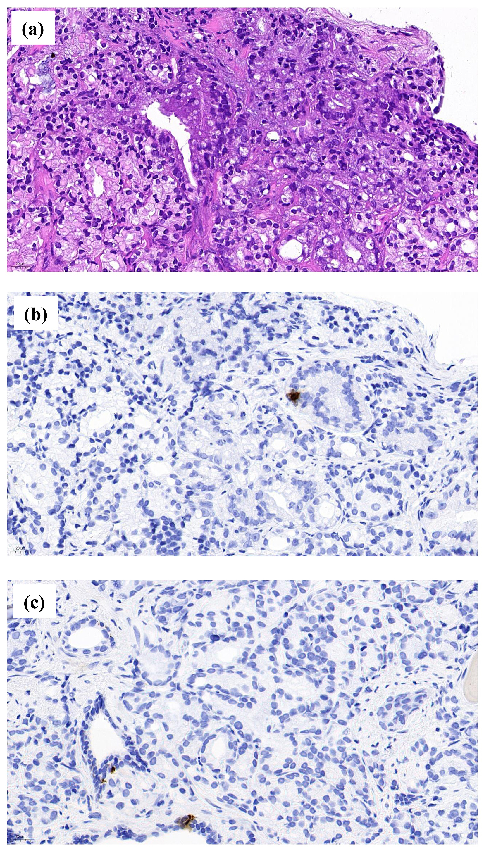 Biopsy specimen of a prostatic acinar adenocarcinoma. (a)
Haematoxylin-eosin staining. (b) Chromogranine A immunohistochemistry showing a
positive cell in the malignant zone. (c) Chromogranine A immunohistochemistry
showing two positive cells in the normal glandular zone (The scale bars show 50
μm).