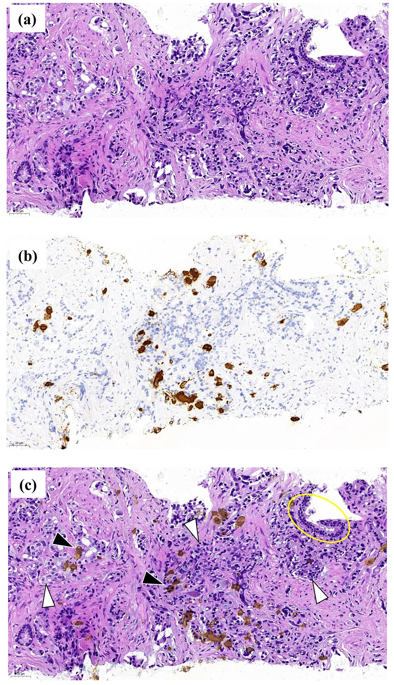 Biopsy specimen of a prostatic mosaic
neuroendocrine/adenocarcinoma. (a) Haematoxylin-eosin staining. (b)
Chromogranine A immunohistochemistry showing numerous positive cells in the
malignant zone. (c) Superposition of Fig. 2a,b. Δ showing malignant
adenocarcinoma cells, ▲ showing neuroendocrine cells, the yellow circle
showing a normal glandular zone. (There are also necrotic zones staining with
chromogranine A, e.g., at the bottom in the middle of the slide. The
scale bars show 50 μm.).