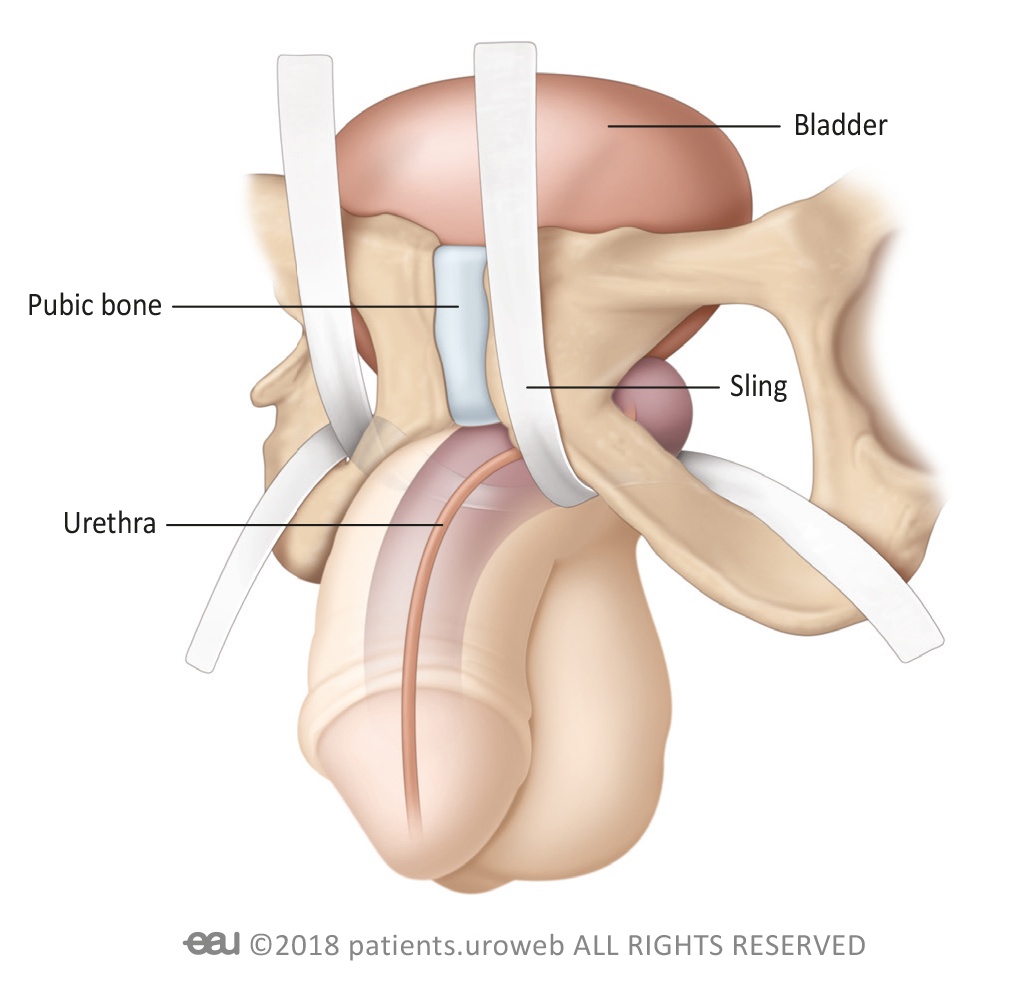 Four-armed male urinary sling placement. Male urinary slings
function to reposition and buttress the urethra to prevent urinary leakage. The
Virtue (Coloplast) sling is a four-armed sling available in the USA. Image
credit: European Association of Urology.